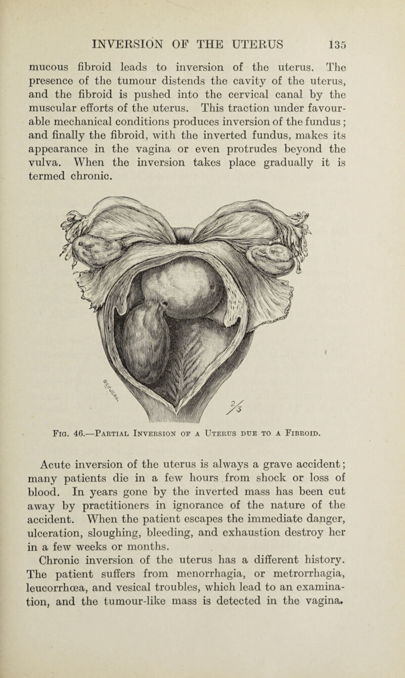 mucous fibroid leads to inversion of the uterus. The presence of the tumour distends the cavity of the uterus, and the fibroid is pushed into the cervical canal by the muscular efforts of the uterus. This traction under favour¬ able mechanical conditions produces inversion of the fundus ; and finally the fibroid, with the inverted fundus, makes its appearance in the vagina or even protrudes beyond the vulva. When the inversion takes place gradually it is termed chronic. Fia. 46.—Partial Inversion of a Uterus due to a Fibroid. Acute inversion of the uterus is always a grave accident; many patients die in a few hours from shock or loss of blood. In years gone by the inverted mass has been cut away by practitioners in ignorance of the nature of the accident. When the patient escapes the immediate danger, ulceration, sloughing, bleeding, and exhaustion destroy her in a few weeks or months. Chronic inversion of the uterus has a different history. The patient suffers from menorrhagia, or metrorrhagia, leucorrhoea, and vesical troubles, which lead to an examina¬ tion, and the tumour-like mass is detected in the vagina.