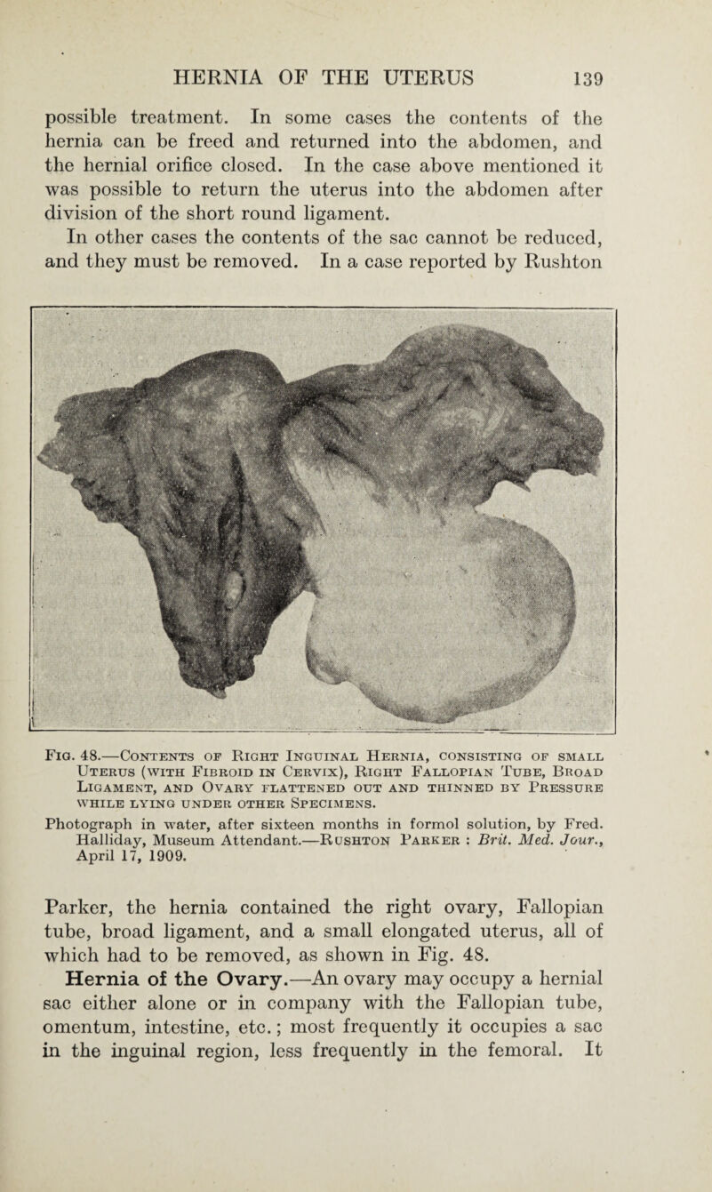 possible treatment. In some cases the contents of the hernia can be freed and returned into the abdomen, and the hernial orifice closed. In the case above mentioned it was possible to return the uterus into the abdomen after division of the short round ligament. In other cases the contents of the sac cannot be reduced, and they must be removed. In a case reported by Rushton Fia. 48.—Contents of Right Inguinal Hernia, consisting of small Uterus (with Fibroid in Cervix), Right Fallopian Tube, Broad Ligament, and Ovary flattened out and thinned by Pressure WHILE LYING UNDER OTHER SPECIMENS. Photograph in water, after sixteen months in formol solution, by Fred. IPalliday, Museum Attendant.—Rushton Parker : Brit. Med. Jour., April 17, 1909. Parker, the hernia contained the right ovary, Fallopian tube, broad ligament, and a small elongated uterus, all of which had to be removed, as shown in Fig. 48. Hernia of the Ovary.—An ovary may occupy a hernial sac either alone or in company with the Fallopian tube, omentum, intestine, etc.; most frequently it occupies a sac in the inguinal region, less frequently in the femoral. It