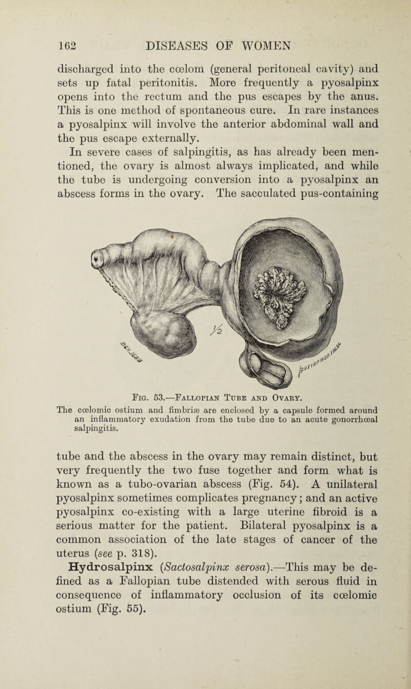 discharged into the coelom (general peritoneal cavity) and sets up fatal peritonitis. More frequently a pyosalpinx opens into the rectum and the pus escapes by the anus. This is one method of spontaneous cure. In rare instances a pyosalpinx will involve the anterior abdominal wall and the pus escape externally. In severe cases of salpingitis, as has already been men¬ tioned, the ovary is almost always implicated, and while the tube is undergoing conversion into a pyosalpinx an abscess forms in the ovary. The sacculated pus-containing Fig. 53.—Fallopian Tube and Ovary. The coelomic ostium and fimbriae are enclosed by a capsule formed around an inflammator}^ exudation from the tube due to an acute gonorrhoeal salpingitis. tube and the abscess in the ovary may remain distinct, but very frequently the two fuse together and form what is known as a tubo-ovarian abscess (Fig. 54). A unilateral pyosalpinx sometimes complicates pregnancy; and an active pyosalpinx co-existing with a large uterine fibroid is a serious matter for the patient. Bilateral pyosalpinx is a common association of the late stages of cancer of the uterus (see p. 318). Hydrosalpinx (Sactosalpinx serosa).—This may be de¬ fined as a Fallopian tube distended with serous fluid in consequence of inflammatory occlusion of its coelomic ostium (Fig. 55).