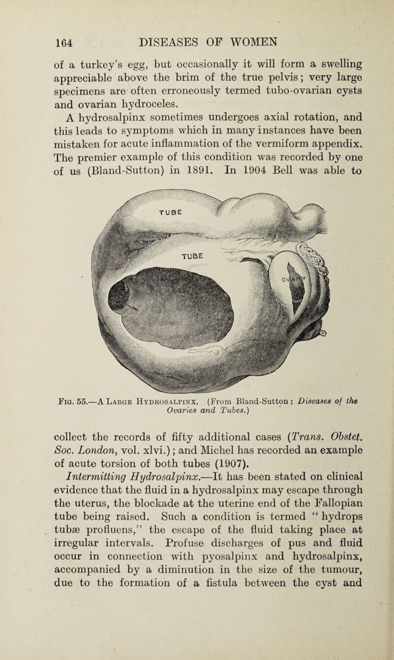of a turkey’s egg, but occasionally it will form a swelling appreciable above the brim of the true pelvis; very large specimens are often erroneously termed tubo-ovarian cysts and ovarian hydroceles. A hydrosalpinx sometimes undergoes axial rotation, and this leads to symptoms which in many instances have been mistaken for acute inflammation of the vermiform appendix. The premier example of this condition was recorded by one of us (Bland-Sutton) in 1891. In 1904 Bell was able to Fig. 55.—A Large Hydrosalpinx. (From Bland-Sutton : Diseases of the Ovaries and Tubes.) collect the records of fifty additional cases (Trans. Obstet. Soc. London, vol. xlvi.); and Michel has recorded an example of acute torsion of both tubes (1907). Intermitting Hydrosalpinx.—It has been stated on clinical evidence that the fluid in a hydrosalpinx may escape through the uterus, the blockade at the uterine end of the Fallopian tube being raised. Such a condition is termed “ hydrops tubse profluens,” the escape of the fluid taking place at irregular intervals. Profuse discharges of pus and fluid occur in connection with pyosalpinx and hydrosalpinx, accompanied by a diminution in the size of the tumour, due to the formation of a fistula between the cyst and