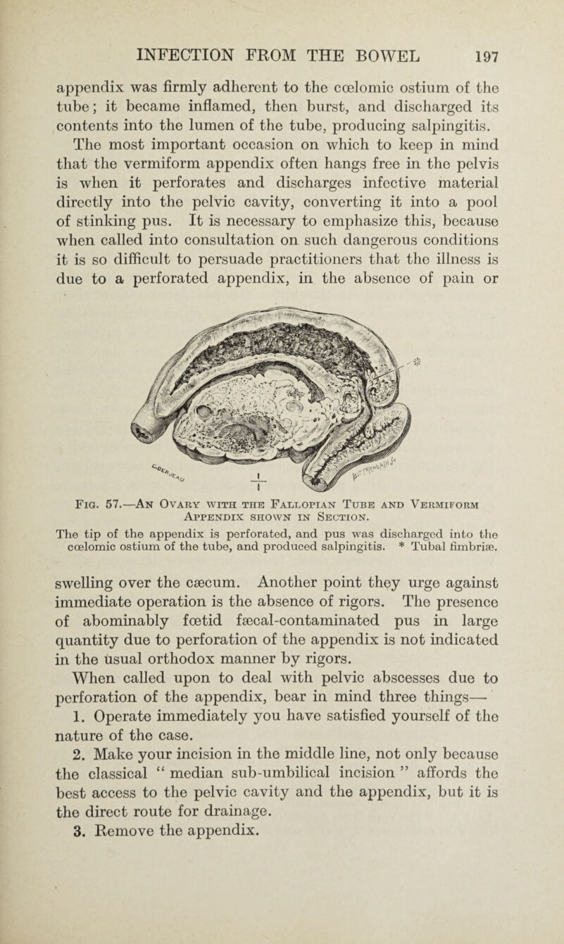 appendix was firmly adherent to the ccelomic ostium of the tube; it became inflamed, then burst, and discharged its contents into the lumen of the tube, producing salpingitis. The most important occasion on which to keep in mind that the vermiform appendix often hangs free in the pelvis is when it perforates and discharges infective material directly into the pelvic cavity, converting it into a pool of stinking pus. It is necessary to emphasize this, because when called into consultation on such dangerous conditions it is so difficult to persuade practitioners that the illness is due to a perforated appendix, in the absence of pain or Fig. 57.—An Ovary with the Fallopian Tube and Vermiform Appendix shown in Section. The tip of the appendix is perforated, and pus was discharged into the coelomic ostium of the tube, and produced salpingitis. * Tubal timbriac. swelling over the caecum. Another point they urge against immediate operation is the absence of rigors. The presence of abominably foetid faecal-contaminated pus in large quantity due to perforation of the appendix is not indicated in the usual orthodox manner by rigors. When called upon to deal with pelvic abscesses due to perforation of the appendix, bear in mind three things— 1. Operate immediately you have satisfied yourself of the nature of the case. 2. Make your incision in the middle line, not only because the classical “ median sub-umbilical incision ” affords the best access to the pelvic cavity and the appendix, but it is the direct route for drainage. 3. Remove the appendix.