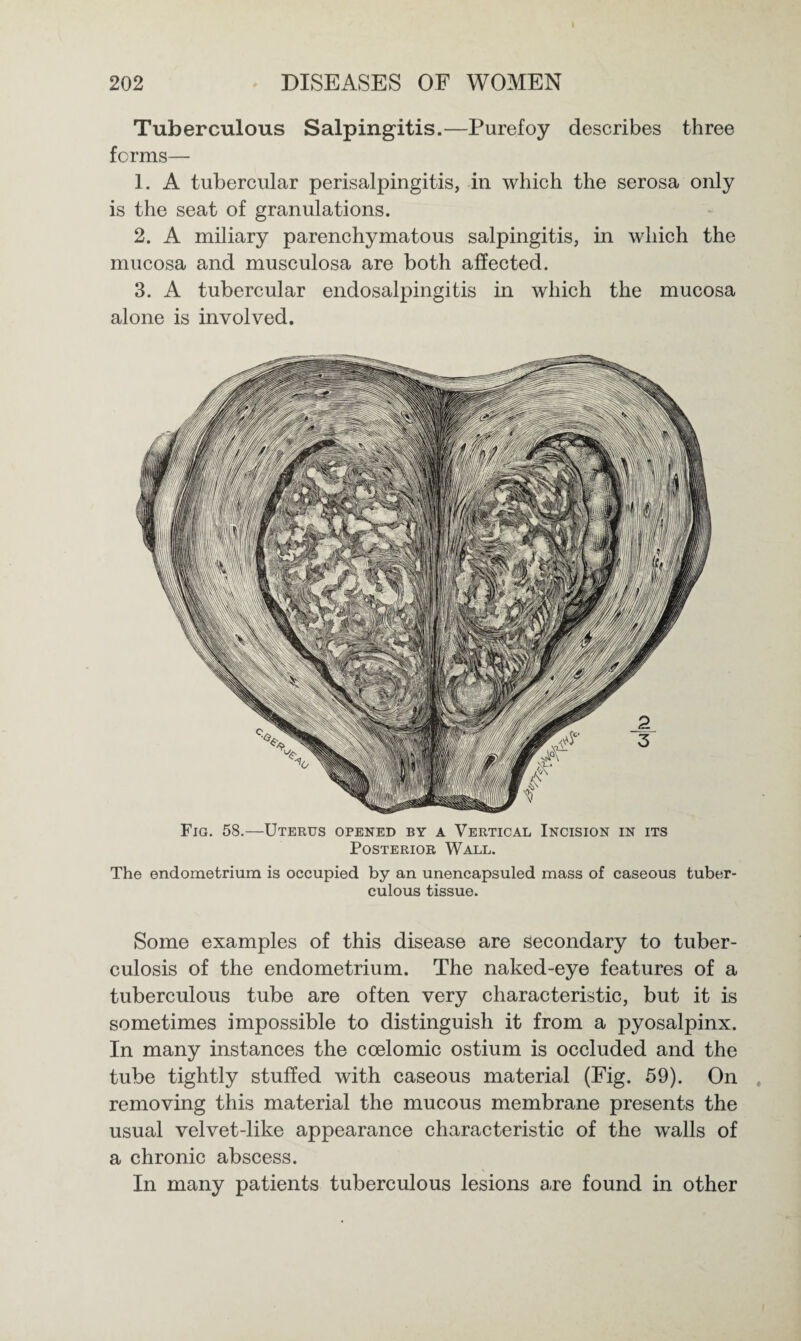 Tuberculous Salpingitis.—Purefoy describes three forms— 1. A tubercular perisalpingitis, in which the serosa only is the seat of granulations. 2. A miliary parenchymatous salpingitis, in which the mucosa and musculosa are both affected. 3. A tubercular endosalpingitis in which the mucosa alone is involved. Fig. 58.—Uterus opened by a Vertical Incision in its Posterior Wall. The endometrium is occupied by an unencapsuled mass of caseous tuber¬ culous tissue. Some examples of this disease are secondary to tuber¬ culosis of the endometrium. The naked-eye features of a tuberculous tube are often very characteristic, but it is sometimes impossible to distinguish it from a pyosalpinx. In many instances the ccelomic ostium is occluded and the tube tightly stuffed with caseous material (Fig. 59). On removing this material the mucous membrane presents the usual velvet-like appearance characteristic of the walls of a chronic abscess. In many patients tuberculous lesions are found in other