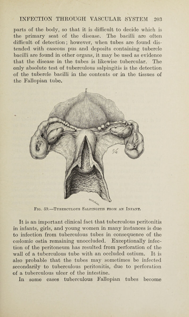 parts of the body, so that it is difficult to decide which is the primary seat of the disease. The bacilli are often difficult of detection; however, when tubes are found dis¬ tended with caseous pus and deposits containing tubercle bacilli are found in other organs, it may be used as evidence that the disease in the tubes is likewise tubercular. The only absolute test of tuberculous salpingitis is the detection of the tubercle bacilli in the contents or in the tissues of the Fallopian tube. Fig. 59.—Tuberculous Salpingitis from an Infant. It is an important clinical fact that tuberculous peritonitis in infants, girls, and young women in many instances is due to infection from tuberculous tubes in consequence of the coelomic ostia remaining unoccluded. Exceptionally infec¬ tion of the peritoneum has resulted from perforation of the wall of a tuberculous tube with an occluded ostium. It is also probable that the tubes may sometimes be infected secondarily to tuberculous peritonitis, due to perforation of a tuberculous ulcer of the intestine. In some cases tuberculous Fallopian tubes become