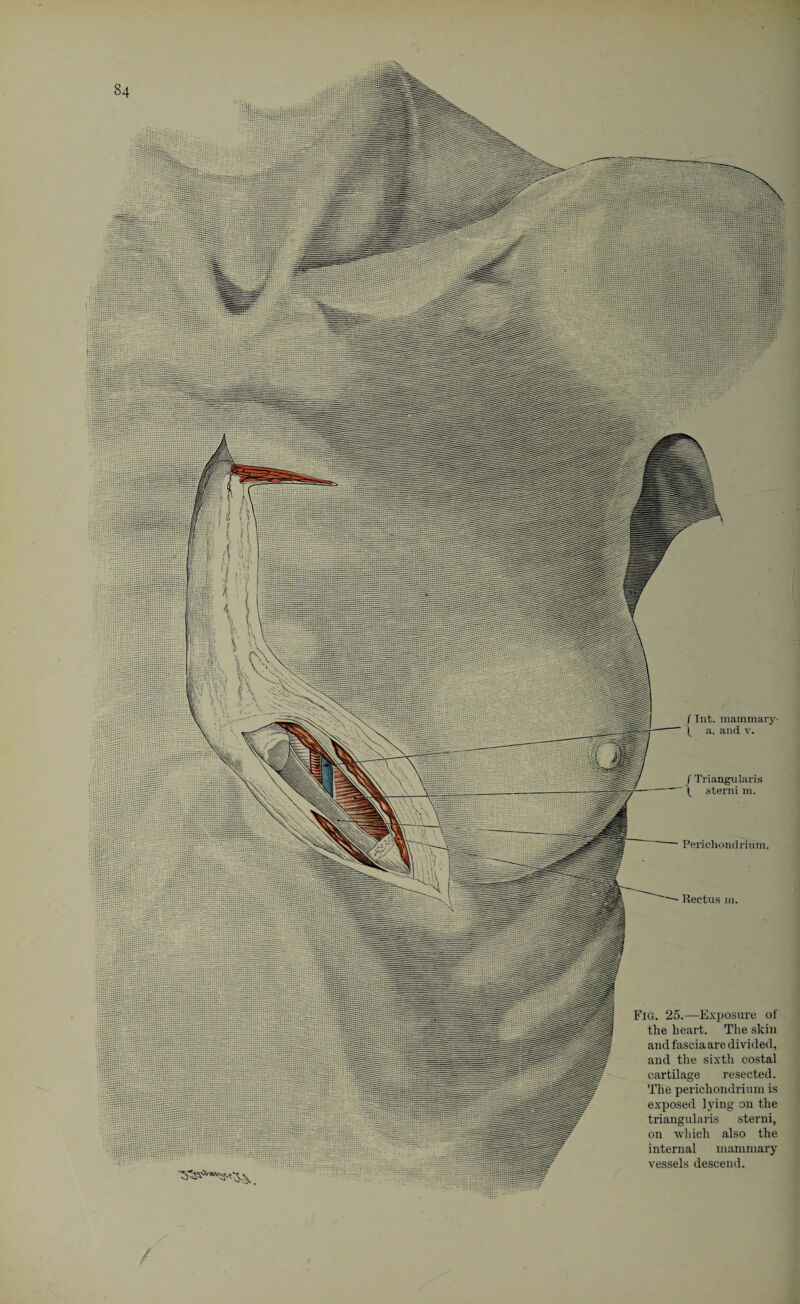 f Triangularis -\ -sterni in. ' Perichondrium. Rectus in. Fig. 25.—Exposure of the heart. The skin and fascia are divided, and the sixth costal cartilage resected. The perichondrium is exposed lying on the triangularis sterni, on which also the internal mammary vessels descend.