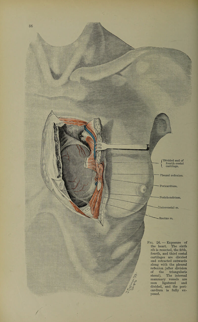 Pleural reflexion. Pericardium. Perichondrium. Intercostal m. Rectus m. Fig. 26. -— Exposure of the heart. The sixth rib is resected, the fifth, fourth, and third costal cartilages are divided and retracted outwards along with the pleural reflexion (after division of the triangularis sterni). The internal mammary vessels are seen ligatured and divided, and the peri¬ cardium is fully ex¬ posed. C Divided end of fourth costal V. cartilage.