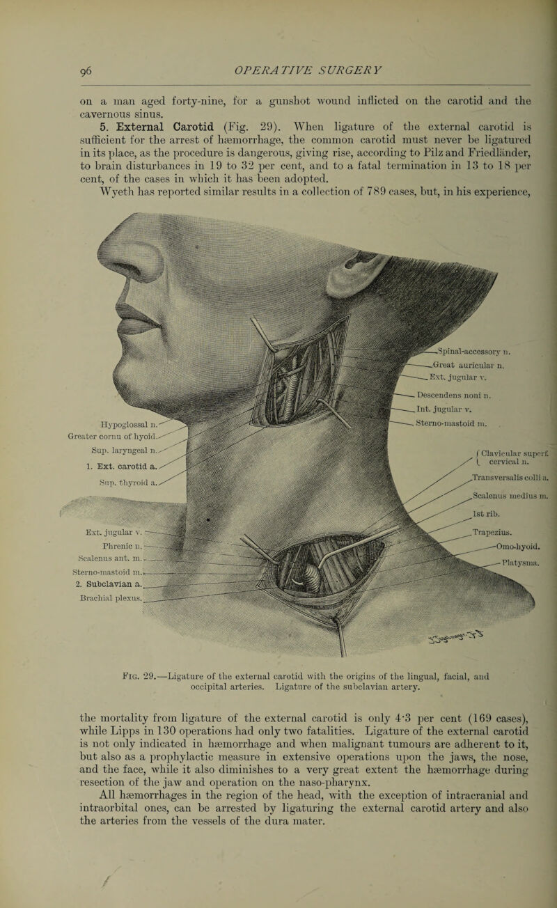 on a man aged forty-nine, for a gunshot wound inflicted on the carotid and the cavernous sinus. 5. External Carotid (Fig. 29). When ligature of the external carotid is sufficient for the arrest of haemorrhage, the common carotid must never be ligatured in its place, as the procedure is dangerous, giving rise, according to Pilz and Friedländer, to brain disturbances in 19 to 32 per cent, and to a fatal termination in 13 to 18 per cent, of the cases in which it has been adopted. Wyeth has reported similar results in a collection of 789 cases, but, in his experience, Platysma. Hypoglossal n. Greater cornu of hyoid Sup. laryngeal n. 1. Ext. carotid a. Sup. thyroid a. | Ext. jugular v. Phrenic n. Scalenus ant. m. Sterno-mastoid m 2. Subclavian a. Brachial plexus. n. auricular n. Ext. jugular v. Descendens noni n. Int. jugular v. Sterno-mastoid m. Scalenus luedius m. 1st rib. Trapezius. f Clavicular super!', t cervical n. colli a. Fig. 29.—Ligature of tlie external carotid with the origins of the lingual, facial, and occipital arteries. Ligature of the subclavian artery. the mortality from ligature of the external carotid is only 4‘3 per cent (169 cases), while Lipps in 130 operations had only two fatalities. Ligature of the external carotid is not only indicated in haemorrhage and when malignant tumours are adherent to it, but also as a prophylactic measure in extensive operations upon the jaws, the nose, and the face, while it also diminishes to a very great extent the haemorrhage during resection of the jaw and operation on the naso-pharynx. All haemorrhages in the region of the head, with the exception of intracranial and intraorbital ones, can be arrested by ligaturing the external carotid artery and also the arteries from the vessels of the dura mater.