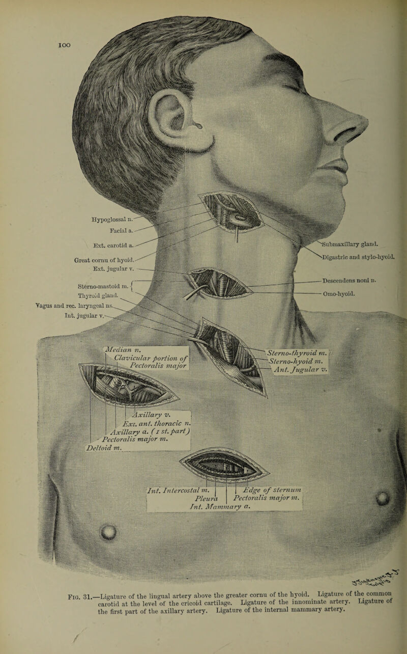 IOO Hypoglossal n. Facial a. 'Submaxillary gland. -Digastric and stylo-hyoid, Ext. carotid a. Great cornu of hyoid, Ext. jugular v. Descendens noni n Sterno-mastoid m. Thyroid gland, laryngeal ns._^ jugular v. Median n. Clavicular portion of l^f^f’cc/ora/is major Sterno-thyroid in. ' Stern o-hyoid m. “ A nt. Jugula r v. Hi!!!! Axillary v. Ext. ant. thoracic n, Axillary a. (i st. part) ■■ ■ Pcctoralis major m. Deltoid m. Int. intercostal m. E Pleura Pecii Tnt. ATawn ary a, Fig. 31.—Ligature of the lingual artery above the greater cornu of the hyoid.. Ligature of the common carotid at the level of the cricoid cartilage. Ligature of the innominate artery. Ligature of the first part of the axillary artery. Ligature of the internal mammary artery.