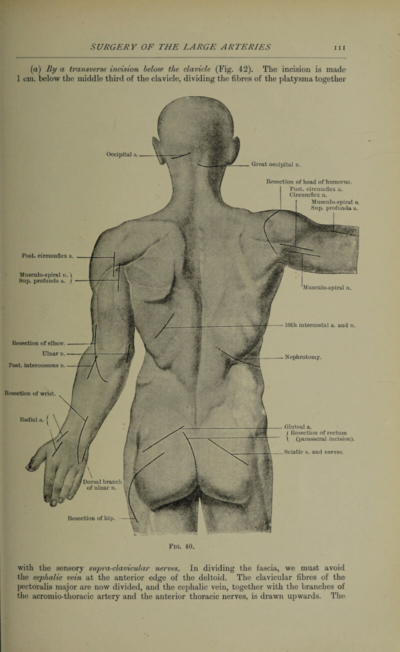 (a) By a transverse incision below the clavicle (Fig. 42). The incision is made 1 cm. below the middle third of the clavicle, dividing the fibres of the platysma together Resection of hip. Resection of head of humerus. Post, circumflex a. Circumflex n. Musculo-spiral n. Sup. profunda a. 10th intercostal a. and u. Resection of wrist. Occipital a. Great occipital n. Post, circumflex a. Musculo-spiral n. '| Sup. profunda a. / Musculo-spiral n. Resection of elbow. Ulnar n. Post, interosseous n. Nephrotomy. Sciatic a. and nerves. Radial a. Gluteal a. I Resection of rectum \ (parasacral incision). Fig. 40. with the sensory supra-clavicular nerves. In dividing the fascia, we must avoid the cephalic vein at the anterior edge of the deltoid. The clavicular fibres of the pectoralis major are now divided, and the cephalic vein, together with the branches of the acromio-thoracic artery and the anterior thoracic nerves, is drawn upwards. The