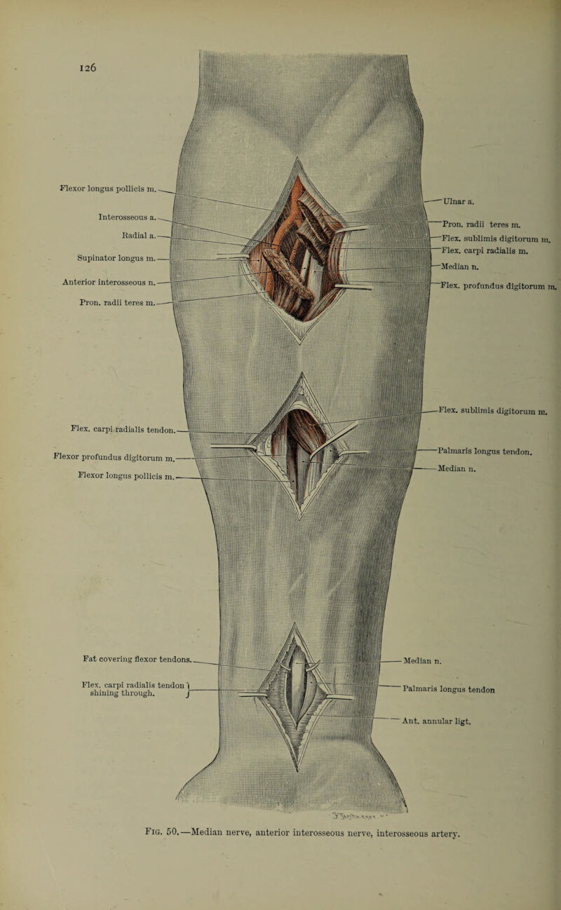 Median n. Palmaris longus tendon Ant. annular ligt. sublimis digitorum m. Palmaris longus tendon. Median n. Flexor longus pollicis m. Interosseous a. Radial a. Supinator longus m. Anterior interosseous n. Pron. radii teres m. Ulnar a. profundus digitorum m. Flex, carpi radialis tendon Fat covering flexor tendons. Flex, carpi radialis tendon shining through. radii teres m. sublimis digitorum m. carpi radialis m. Flexor profundus digitorum Flexor longus pollicis m. Fig. 50.—Median nerve, anterior interosseous nerve, interosseous artery.