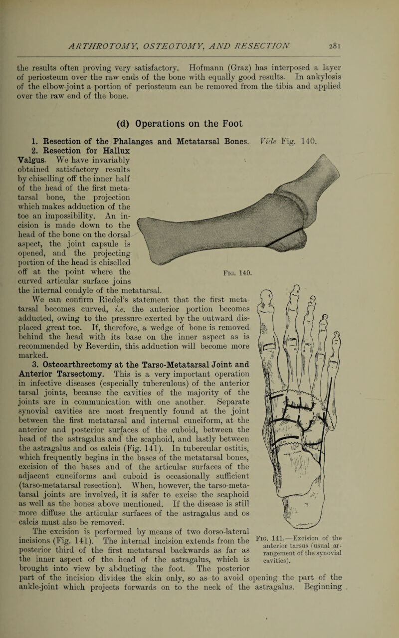 the results often proving very satisfactory. Hofmann (Graz) has interposed a layer of periosteum over the raw ends of the bone with equally good results. In ankylosis of the elbow-joint a portion of periosteum can be removed from the tibia and applied over the raw end of the bone. (d) Operations on the Foot 1. Resection of the Phalanges and Metatarsal Bones. 2. Resection for Hallux Vide Fig. 140. Fig. 140. Valgus. We have invariably obtained satisfactory results by chiselling off the inner half of the head of the first meta¬ tarsal bone, the projection which makes adduction of the toe an impossibility. An in¬ cision is made down to the head of the bone on the dorsal aspect, the joint capsule is opened, and the projecting portion of the head is chiselled off at the point where the curved articular surface joins the internal condyle of the metatarsal. We can confirm Riedel’s statement that the first meta¬ tarsal becomes curved, i.e. the anterior portion becomes adducted, owing to the pressure exerted by the outward dis¬ placed great toe. If, therefore, a wedge of bone is removed behind the head with its base on the inner aspect as is recommended by Reverdin, this adduction will become more marked. 3. Osteoarthrectomy at the Tarso-Metatarsal Joint and Anterior Tarsectomy. This is a very important operation in infective diseases (especially tuberculous) of the anterior tarsal joints, because the cavities of the majority of the joints are in communication with one another. Separate synovial cavities are most frequently found at the joint between the first metatarsal and internal cuneiform, at the anterior and posterior surfaces of the cuboid, between the head of the astragalus and the scaphoid, and lastly between the astragalus and os calcis (Fig. 141). In tubercular ostitis, which frequently begins in the bases of the metatarsal bones, excision of the bases and of the articular surfaces of the adjacent cuneiforms and cuboid is occasionally sufficient (tarso-metatarsal resection). When, however, the tarso-meta- tarsal joints are involved, it is safer to excise the scaphoid as well as the bones above mentioned. If the disease is still more diffuse the articular surfaces of the astragalus and os calcis must also be removed. The excision is performed by means of two dorso-lateral incisions (Fig. 141). The internal incision extends from the posterior third of the first metatarsal backwards as far as the inner aspect of the head of the astragalus, which is brought into view by abducting the foot. The posterior part of the incision divides the skin only, so as to avoid opening the part of the ankle-joint which projects forwards on to the neck of the astragalus. Beginning Fig. 141.—Excision of the anterior tarsus (usual ar¬ rangement of the synovial cavities).