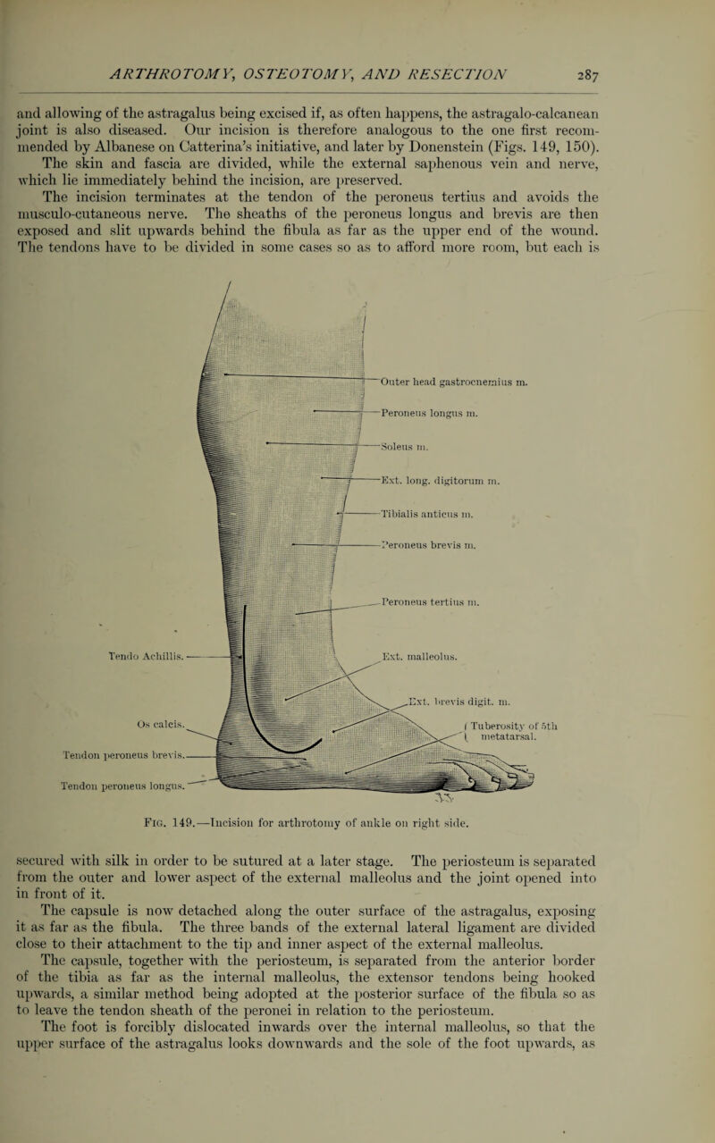 and allowing of the astragalus being excised if, as often happens, the astragalo-calcanean joint is also diseased. Our incision is therefore analogous to the one first recom¬ mended by Albanese on Catterina’s initiative, and later by Donenstein (Figs. 149, 150). The skin and fascia are divided, while the external saphenous vein and nerve, which lie immediately behind the incision, are preserved. The incision terminates at the tendon of the peroneus tertius and avoids the musculo-cutaneous nerve. The sheaths of the peroneus longus and brevis are then exposed and slit upwards behind the fibula as far as the upper end of the wound. The tendons have to be divided in some cases so as to afford more room, but each is secured with silk in order to be sutured at a later stage. The periosteum is separated from the outer and lower aspect of the external malleolus and the joint opened into in front of it. The capsule is now detached along the outer surface of the astragalus, exposing it as far as the fibula. The three bands of the external lateral ligament are divided close to their attachment to the tip and inner aspect of the external malleolus. The capsule, together with the periosteum, is separated from the anterior border of the tibia as far as the internal malleolus, the extensor tendons being hooked upwards, a similar method being adopted at the posterior surface of the fibula so as to leave the tendon sheath of the peronei in relation to the periosteum. The foot is forcibly dislocated inwards over the internal malleolus, so that the upper surface of the astragalus looks downwards and the sole of the foot upwards, as