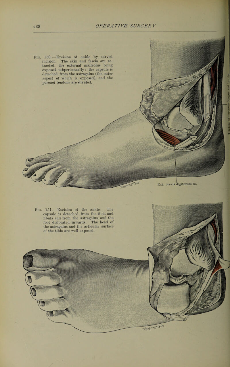 Ext. brevis digitorum in. Fig. 150.—Excision of ankle by curved incision. The skin and fascia are re¬ tracted, the external malleolus being exposed subperiosteally : the capsule is detached from the astragalus (the outer aspect of which is exposed), and the peronei tendons are divided.