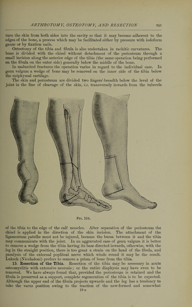 Fig. 154. of the tibia to the edge of the calf muscles. After separation of the periosteum the chisel is applied in the direction of the skin incision. The attachment of the ligamentum patellae must not be injured, because the bursa between it and the tibia may communicate with the joint. In an aggravated case of genu valgum it is better to remove a wedge from the tibia having its base directed inwards, otherwise, with the leg in the straight position, there is too great a strain on the head of the fibula, and paralysis of the external popliteal nerve which winds round it may be the result. Luksch (Nicoladoni) prefers to remove a prism of bone from the tibia. 15. Resection of the Tibia. Resection of the tibia may be necessary in acute osteomyelitis with extensive necrosis; or the entire diaphysis may have even to be removed. We have always found that, provided the periosteum is retained and the fibula is preserved as a support, complete regeneration of the tibia is to be expected. Although the upper end of the fibula projects upwards and the leg has a tendency to take the varus position owing to the ti'action of the new-formed and somewhat 19 a turn the skin from both sides into the cavity so that it may become adherent to the edges of the bone, a process which may be facilitated either by pressure with iodoform gauze or by fixation nails. Osteotomy of the tibia and fibula is also undertaken in rachitic curvatures. The bone is divided with the chisel without detachment of the periosteum through a small incision along the anterior edge of the tibia (the same operation being performed on the fibula on the outer side) generally below the middle of the bone. In malunited fractures the operation varies in regard to the individual case. In genu valgum a wedge of bone may be removed on the inner side of the tibia below the epiphyseal cartilage. The skin and periosteum are divided two fingers’-breadth below the level of the joint in the line of cleavage of the skin, i.e. transversely inwards from the tubercle