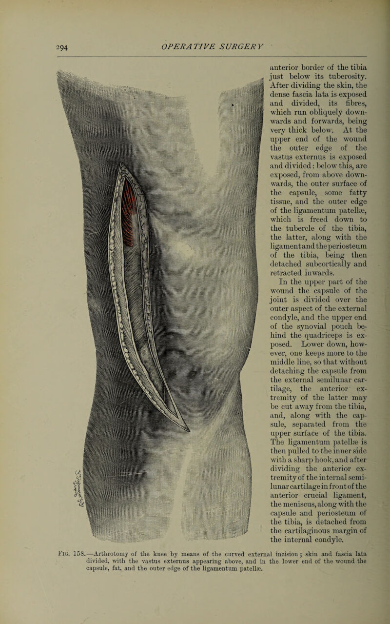 anterior border of the tibia just below its tuberosity. After dividing the skin, the dense fascia lata is exposed and divided, its fibres, which run obliquely down¬ wards and forwards, being very thick below. At the upper end of the wound the outer edge of the vastus externus is exposed and divided: below this, are exposed, from above down¬ wards, the outer surface of the capsule, some fatty tissue, and the outer edge of the ligamentum patelke, which is freed down to the tubercle of the tibia, the latter, along with the ligament and the periosteum of the tibia, being then detached subcortically and retracted inwards. In the upper part of the wound the capsule of the joint is divided over the outer aspect of the external condyle, and the upper end of the synovial pouch be¬ hind the quadriceps is ex¬ posed. Lower down, how¬ ever, one keeps more to the middle line, so that without detaching the capsule from the external semilunar car¬ tilage, the anterior ex¬ tremity of the latter may be cut away from the tibia, and, along with the cap¬ sule, separated from the upper surface of the tibia. The ligamentum patelke is then pulled to the inner side with a sharp hook, and after dividing the anterior ex¬ tremity of the internal semi¬ lunar cartilage in front of the anterior crucial ligament, the meniscus, along with the capsule and periosteum of the tibia, is detached from the cartilaginous margin of the internal condyle. Flu. 158.—Arthrotomy of the knee by means of the curved external incision ; skin and fascia lata divided, with the vastus externus appearing above, and in the lower end of the wound the capsule, fat, and the outer edge of the ligamentum patellre.