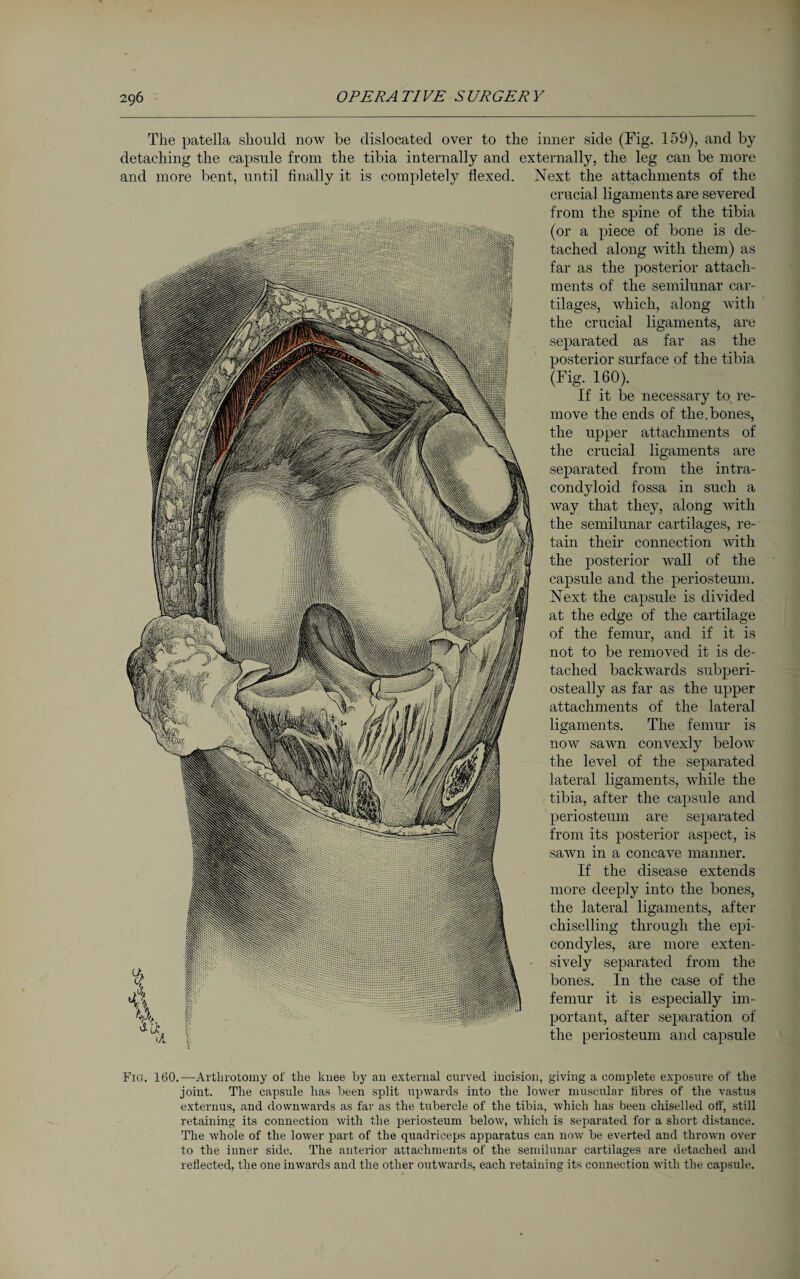 The patella should now be dislocated over to the inner side (Fig. 159), and by detaching the capsule from the tibia internally and externally, the leg can be more and more bent, until finally it is completely flexed. Next the attachments of the crucial ligaments are severed from the spine of the tibia (or a piece of bone is de¬ tached along with them) as far as the posterior attach¬ ments of the semilunar car¬ tilages, which, along with the crucial ligaments, are separated as far as the posterior surface of the tibia (Fig. 160). If it be necessary to re¬ move the ends of the.bones, the upper attachments of the crucial ligaments are separated from the intra- condyloid fossa in such a way that they, along with the semilunar cartilages, re¬ tain their connection with the posterior wall of the capsule and the periosteum. Next the capsule is divided at the edge of the cartilage of the femur, and if it is not to be removed it is de¬ tached backwards subperi- osteally as far as the upper attachments of the lateral ligaments. The femur is now sawn convexly below the level of the separated lateral ligaments, while the tibia, after the capsule and periosteum are separated from its posterior aspect, is sawn in a concave manner. If the disease extends more deeply into the bones, the lateral ligaments, after chiselling through the epi- condyles, are more exten¬ sively separated from the bones. In the case of the femur it is especially im¬ portant, after separation of the periosteum and capsule Fig. 160.—Arthrotomy of tlie knee by an external curved incision, giving a complete exposure of tlie joint. The capsule has been split upwards into the lower muscular fibres of the vastus externus, and downwards as far as the tubercle of the tibia, which has been chiselled off, still retaining its connection with the periosteum below, which is separated for a short distance. The whole of the lower part of the quadriceps apparatus can now be everted and thrown over to the inner side. The anterior attachments of the semilunar cartilages are detached and reflected, the one inwards and the other outwards, each retaining its connection with the capsule.