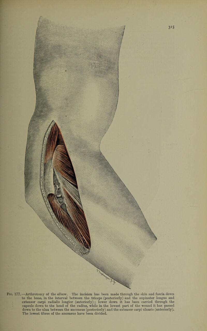 Fig. 177.—Arthrotomy of the elbow. The incision has been made through the skin and fascia down to the bone, in the interval between the triceps (posteriorly) and the supinator longus and extensor carpi radialis longior (anteriorly) ; lower down it has been carried through the capsule down to the head of the radius, while in the lowest part of the wound it has passed down to the ulna between the anconeus (posteriorly) and the extensor carpi ulnaris (anteriorly). The lowest fibres of the anconeus have been divided.