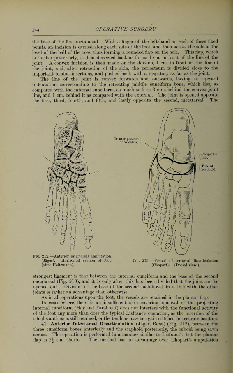 the base of the first metatarsal. With a linger of the left-hand on each of these fixed points, an incision is carried along each side of the foot, and then across the sole at the level of the ball of the toes, thus forming a rounded flap on the sole. This Hap, which is thicker posteriorly, is then dissected back as far as 1 cm. in front of the line of the joint. A convex incision is then made on the dorsum, 1 cm. in front of the line of the joint, and, after retraction of the skin, the periosteum is divided close to the important tendon insertions, and pushed back with a raspatory as far as the joint. The line of the joint is convex forwards and outwards, having an upward indentation corresponding to the retreating middle cuneiform bone, which lies, as compared with the internal cuneiform, as much as 2 to 3 mm. behind the convex joint line, and 1 cm. behind it as compared with the external. The joint is opened opposite the first, third, fourth, and fifth, and lastly opposite the second, metatarsal. The Fig. 212.—Anterior iutertarsal amputation (Jäger). Horizontal section of foot (after Heitzmann). Fig. 213.—Posterior iutertarsal disarticulation (Cliopart). (Dorsal view.) strongest ligament is that between the internal cuneiform and the base of the second metatarsal (Fig. 210), and it is only after this has been divided that the joint can be opened out. Division of the base of the second metatarsal in a line with the other joints is rather an advantage than otherwise. As in all operations upon the foot, the vessels are retained in the plantar Hap. In cases where there is an insufficient skin covering, removal of the projecting internal cuneiform (Hey and Faraboeuf) does not interfere with the functional activity of the foot any more than does the typical Lisfranc’s operation, as the insertion of the tibialis anticus is still retained, or the tendons may be again stitched in accurate position. 41. Anterior Intertarsal Disarticulation (Jäger, Bona) (Fig. 212), between the three cuneiform bones anteriorly and the scaphoid posteriorly, the cuboid being sawn across. The operation is performed in a manner similar to Lisfranc’s, but the plantar flap is 2|- cm. shorter. The method has an advantage over Chopart’s amputation