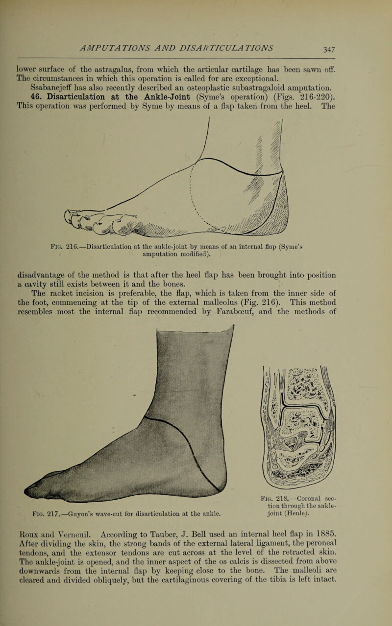A MP UTA TIONS A ND DI SA R TI CU LA TIONS lower surface of the astragalus, from which the articular cartilage has been sawn olf. The circumstances in which this operation is called for are exceptional. Ssabanejeff has also recently described an osteoplastic subastragaloid amputation. 46. Disarticulation at the Ankle-Joint (Syme’s operation) (Figs. 216-220). This operation was performed by Syme by means of a flap taken from the heel. The Fig. 216.—Disarticulation at the ankle-joint by means of an internal flap (Syme’s amputation modified). disadvantage of the method is that after the heel flap has been brought into position a cavity still exists between it and the bones. The racket incision is preferable, the flap, which is taken from the inner side of the foot, commencing at the tip of the external malleolus (Fig. 216). This method resembles most the internal flap recommended by Faraboeuf, and the methods of Fig. 217.—Gnyon’s wave-cut for disarticulation at the ankle. Fig. 218.—Coronal sec¬ tion through the ankle- joint (Heule). Roux and Verneuil. According to Tauber, J. Bell used an internal heel flap in 1885. After dividing the skin, the strong bands of the external lateral ligament, the peroneal tendons, and the extensor tendons are cut across at the level of the retracted skin. The ankle-joint is opened, and the inner aspect of the os calcis is dissected from above downwards from the internal flap by keeping close to the bone. The malleoli are cleared and divided obliquely, but the cartilaginous covering of the tibia is left intact.