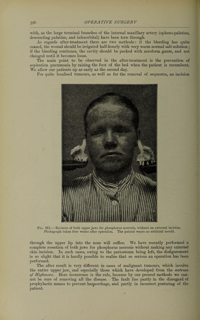 with, as the large terminal branches of the internal maxillary artery (spheno-palatine, descending palatine, and infraorbital) have been torn through. As regards after-treatment there are two methods: if the bleeding has quite ceased, the wound should be irrigated half-hourly with very warm normal salt solution ; if the bleeding continues, the cavity should be packed with xeroform gauze, and not changed until it becomes loose. The main point to be observed in the after-treatment is the prevention of aspiration pneumonia by raising the foot of the bed when the patient is recumbent. We allow our patients up as early as the second day. For quite localised tumours, as well as for the removal of sequestra, an incision Fig. 261.—Excision of both upper jaws for phosphorus necrosis, without an external incision. Photograph taken four weeks after operation. The patieut wears no artificial mould. through the upper lip into the nose will suffice. We have recently performed a complete resection of both jaws for phosphorus necrosis without making any external skin incision. In such cases, owing to the periosteum being left, the disfigurement is so slight that it is hardly possible to realise that so serious au operation has been performed. The after result is very different in cases of malignant tumours, which involve the entire upper jaw, and especially those which have developed from the antrum of Highmore,. Here recurrence is the rule, because by our present methods we can¬ not be sure of removing all the disease. The fault lies partly in the disregard of prophylactic means to prevent haunorrhage, and partly in incorrect posturing of the patient.