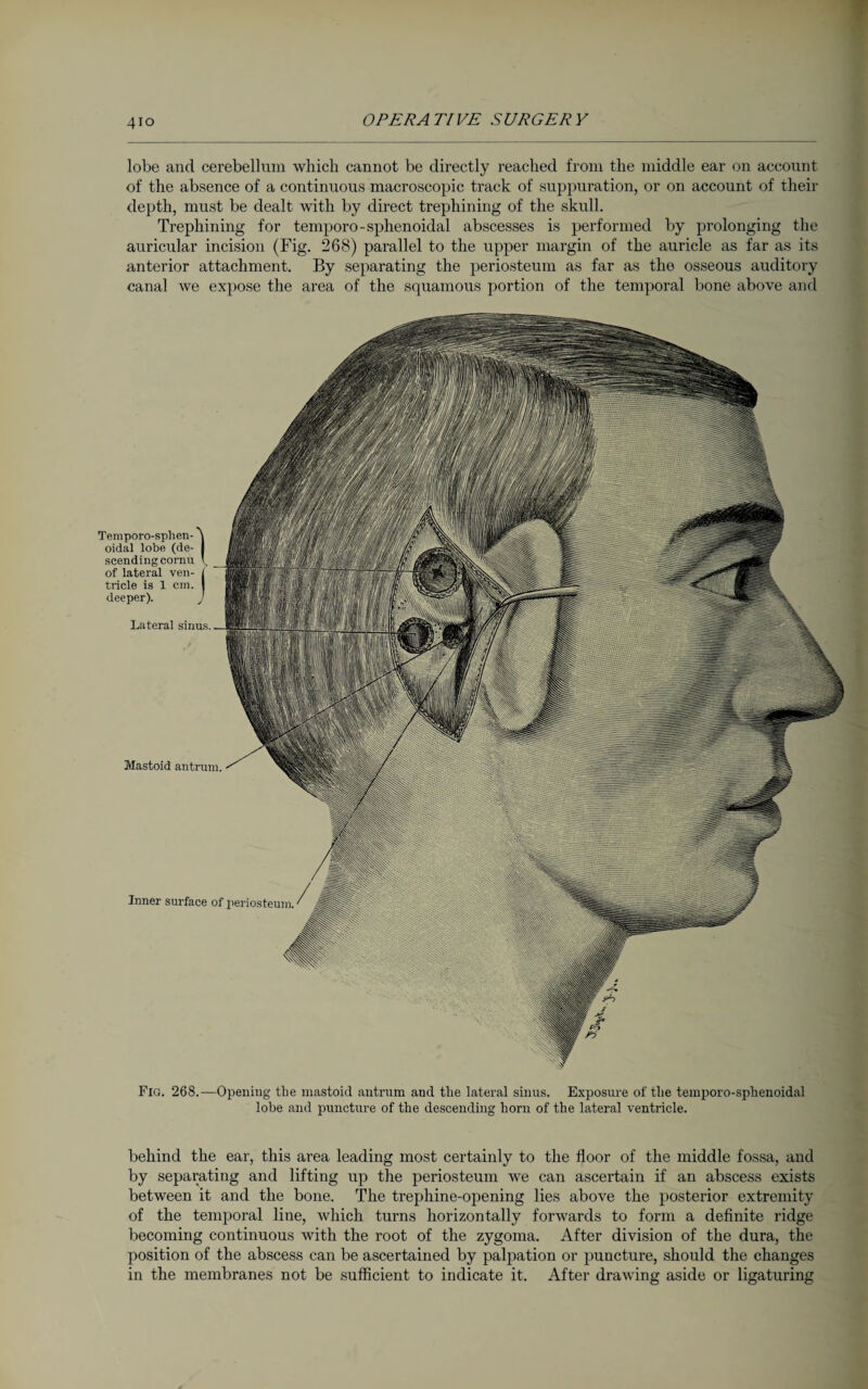 4io lobe and cerebellum which cannot be directly reached from the middle ear on account of the absence of a continuous macroscopic track of suppuration, or on account of their depth, must be dealt with by direct trephining of the skull. Trephining for temporo-sphenoidal abscesses is performed by prolonging the auricular incision (Fig. 268) parallel to the upper margin of the auricle as far as its anterior attachment. By separating the periosteum as far as the osseous auditory canal Ave expose the area of the squamous portion of the temporal bone above and Mastoid antrum. Temporo-splien- t oidal lobe (de- I scending cornu l, of lateral ven¬ tricle is X cm. deeper). Lateral sinus. Inner surface of periosteum. Fig. 268.—Opening the mastoid antrum and the lateral sinus. Exposure of the temporo-sphenoidal lobe and puncture of the descending horn of the lateral ventricle. behind the ear, this area leading most certainly to the floor of the middle fossa, and by separating and lifting up the periosteum Ave can ascertain if an abscess exists between it and the bone. The trephine-opening lies above the posterior extremity of the temporal line, which turns horizontally forwards to form a definite ridge becoming continuous with the root of the zygoma. After division of the dura, the position of the abscess can be ascertained by palpation or puncture, should the changes in the membranes not be sufficient to indicate it. After draAving aside or ligaturing