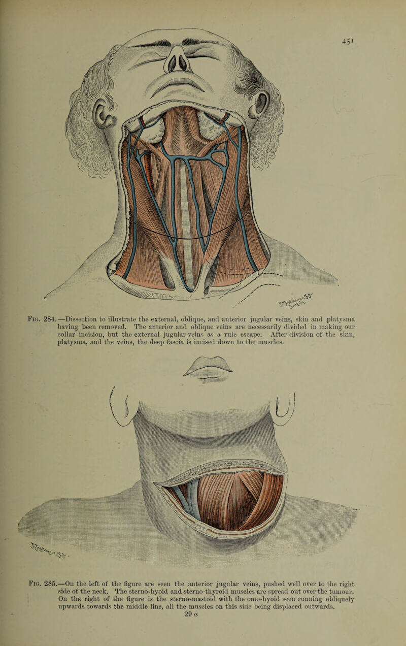 Fig. 284.—Dissection to illustrate the external, oblique, anil anterior jugular veins, skin and platysma having been removed. The anterior and oblique veins are necessarily divided in making our collar incision, but the external jugular veins as a rule escape. After division of the skin, platysma, and the veins, the deep fascia is incised down to the muscles. Fig. 285.—On the left of the figure are seen the anterior jugular veins, pushed well over to the right side of the neck. The sterno-hyoid and sterno-thyroid muscles are spread out over the tumour. On the right of the figure is the sterno-mastoid with the omo-hyoid seen running obliquely upwards towards the middle line, all the muscles on this side being displaced outwards. 29 a