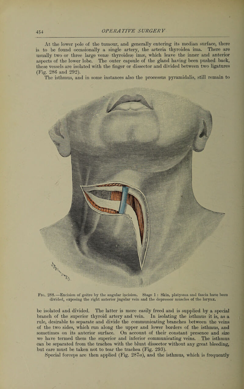 At the lower pole of the tumour, and generally entering its median surface, there is to be found occasionally a single artery, the arteria thyroidea ima. There are usually two or three large venae thyroideae imae, which leave the inner and anterior aspects of the lower lobe. The outer capsule of the gland having been pushed back, these vessels are isolated with the finger or dissector and divided between two ligatures (Fig. 286 and 292). The isthmus, and in some instances also the processus pyramidalis, still remain to Fig. 288.—Excision of goitre by the angular incision. Stage 1 : Skin, platysma and fascia have been divided, exposing the right anterior jugular vein and the depressor muscles of the larynx. be isolated and divided. The latter is more easily freed and is supplied by a special branch of the superior thyroid artery and vein. In isolating the isthmus it is, as a rule, desirable to separate and divide the communicating branches between the veins of the two sides, which run along the upper and lower borders of the isthmus, and sometimes on its anterior surface. On account of their constant presence and size we have termed them the superior and inferior communicating veins. The isthmus can be separated from the trachea with the blunt dissector without any great bleeding, but care must be taken not to tear the trachea (Fig. 293). Special forceps are then applied (Fig. 287<z), and the isthmus, which is frequently