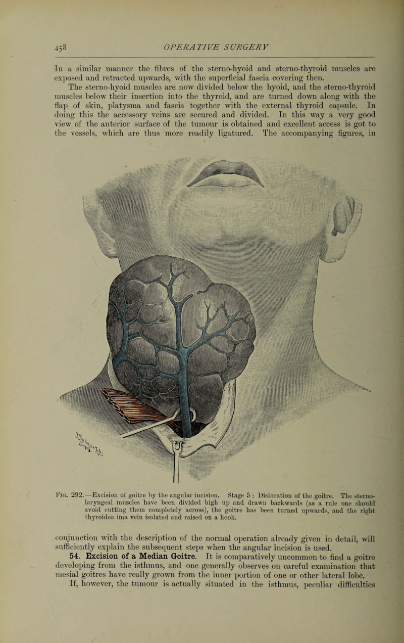 Fig. 292.—Excision of goitre by the angular incision. Stage 5 : Dislocation of the goitre. The sterno- laryngeal muscles have been divided high up and drawn backwards (as a rule one should avoid cutting them completely across), the goitre has been turned upwards, and the right thyroidea ima vein isolated and raised on a hook. conjunction with the description of the normal operation already given in detail, will sufficiently explain the subsequent steps when the angular incision is used. 54. Excision of a Median Goitre. It is comparatively uncommon to find a goitre developing from the isthmus, and one generally observes on careful examination that mesial goitres have really grown from the inner portion of one or other lateral lobe. If, however, the tumour is actually situated in the isthmus, peculiar difficulties In a similar manner the fibres of the sterno-hyoid and sterno-thyroid muscles are exposed and retracted upwards, with the superficial fascia covering then. The sterno-hyoid muscles are now divided below the hyoid, and the sterno-thyroid muscles below their insertion into the thyroid, and are turned down along with the flap of skin, platysma and fascia together with the external thyroid capsule. In doing this the accessory veins are secured and divided. In this way a very good view of the anterior surface of the tumour is obtained and excellent access is got to the vessels, which are thus more readily ligatured. The accompanying figures, in