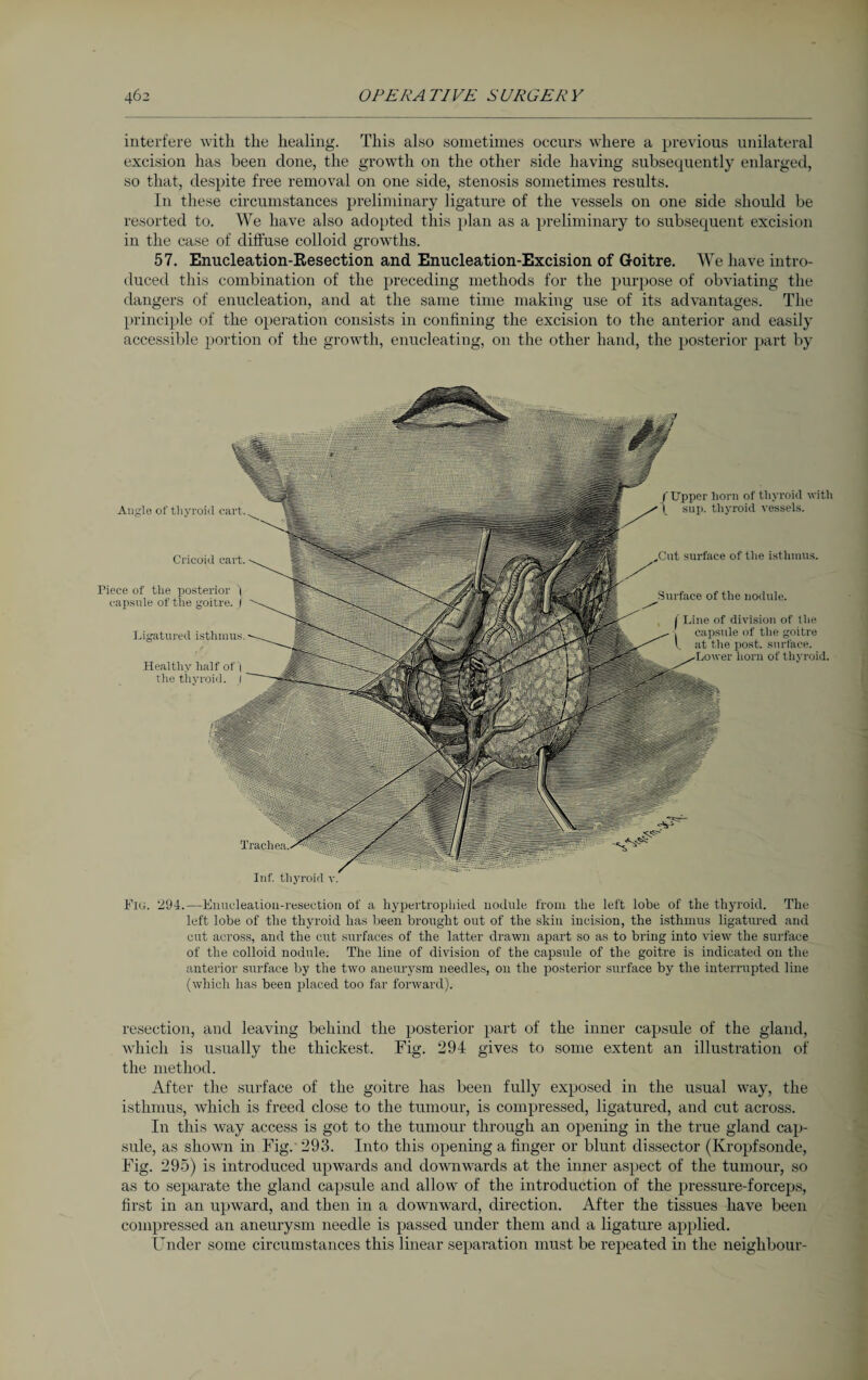 interfere with the healing. This also sometimes occurs where a previous unilateral excision has been clone, the growth on the other side having subsequently enlarged, so that, despite free removal on one side, stenosis sometimes results. In these circumstances preliminary ligature of the vessels on one side should be resorted to. We have also adopted this plan as a preliminary to subsequent excision in the case of diffuse colloid growths. 57. Enucleation-Resection and Enucleation-Excision of Goitre. We have intro¬ duced this combination of the preceding methods for the purpose of obviating the dangers of enucleation, and at the same time making use of its advantages. The principle of the operation consists in confining the excision to the anterior and easily accessible portion of the growth, enucleating, on the other hand, the posterior part by Angle of'thyroid cart Cricoid cart Piece of the posterior ~| capsule of the goitre. I Ligatured isthmus Healthy half of 1 the thyroid. I Inf. thyroid v. /Upper horn of thyroid with \ sup. thyroid vessels. surface of the isthmus. Surface of the nodule. ( Line of division of the capsule of the goitre i. at the post, surface. Lower horn of thyroid. Fic. 294.—Enucleation-resection of a hypertrophied nodule from the left lobe of the thyroid. The left lobe of the thyroid has been brought out of the skin incision, the isthmus ligatured and cut across, and the cut surfaces of the latter drawn apart so as to bring into view the surface of the colloid nodule. The line of division of the capsule of the goitre is indicated on the anterior surface by the two aneurysm needles, on the posterior surface by the interrupted line (which has been placed too far forward). resection, and leaving behind the posterior part of the inner capsule of the gland, which is usually the thickest. Fig. 294 gives to some extent an illustration of the method. After the surface of the goitre has been fully exposed in the usual way, the isthmus, which is freed close to the tumour, is compressed, ligatured, and cut across. In this way access is got to the tumour through an opening in the true gland cap¬ sule, as shown in Fig.' 293. Into this opening a finger or blunt dissector (Kropfsonde, Fig. 295) is introduced upwards and downwards at the inner aspect of the tumour, so as to separate the gland capsule and allow of the introduction of the pressure-forceps, first in an upward, and then in a downward, direction. After the tissues have been compressed an aneurysm needle is passed under them and a ligature applied. Under some circumstances this linear separation must be repeated in the neighbour-