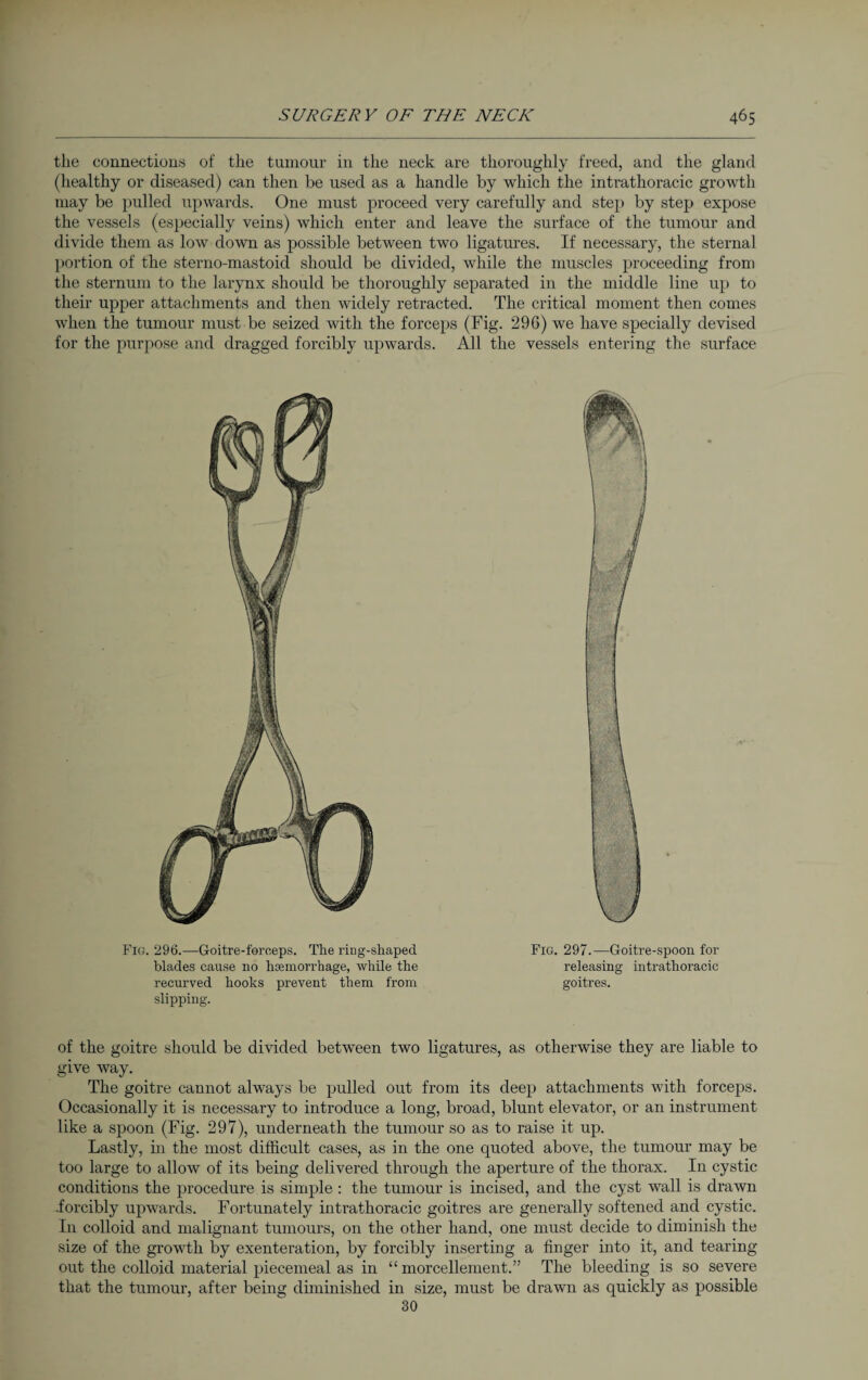 the connections of the tumour in the neck are thoroughly freed, and the gland (healthy or diseased) can then be used as a handle by which the intrathoracic growth may be pulled upwards. One must proceed very carefully and step by step expose the vessels (especially veins) which enter and leave the surface of the tumour and divide them as low down as possible between two ligatures. If necessary, the sternal portion of the sterno-mastoid should be divided, while the muscles proceeding from the sternum to the larynx should be thoroughly separated in the middle line up to their upper attachments and then widely retracted. The critical moment then comes when the tumour must be seized with the forceps (Fig. 296) we have specially devised for the purpose and dragged forcibly upwards. All the vessels entering the surface Flo. 296.—Goitre-forceps. The ring-shaped blades cause no hcemorrhage, while the recurved hooks prevent them from slipping. Fig. 297.—Goitre-spoon for releasing intrathoracic goitres. of the goitre should be divided between two ligatures, as otherwise they are liable to give way. The goitre cannot always be pulled out from its deep attachments with forceps. Occasionally it is necessary to introduce a long, broad, blunt elevator, or an instrument like a spoon (Fig. 297), underneath the tumour so as to raise it up. Lastly, in the most difficult cases, as in the one quoted above, the tumour may be too large to allow of its being delivered through the aperture of the thorax. In cystic conditions the procedure is simple : the tumour is incised, and the cyst wall is drawn .forcibly upwards. Fortunately intrathoracic goitres are generally softened and cystic. In colloid and malignant tumours, on the other hand, one must decide to diminish the size of the growth by exenteration, by forcibly inserting a finger into it, and tearing out the colloid material piecemeal as in “ morcellement.” The bleeding is so severe that the tumour, after being diminished in size, must be drawn as quickly as possible 30