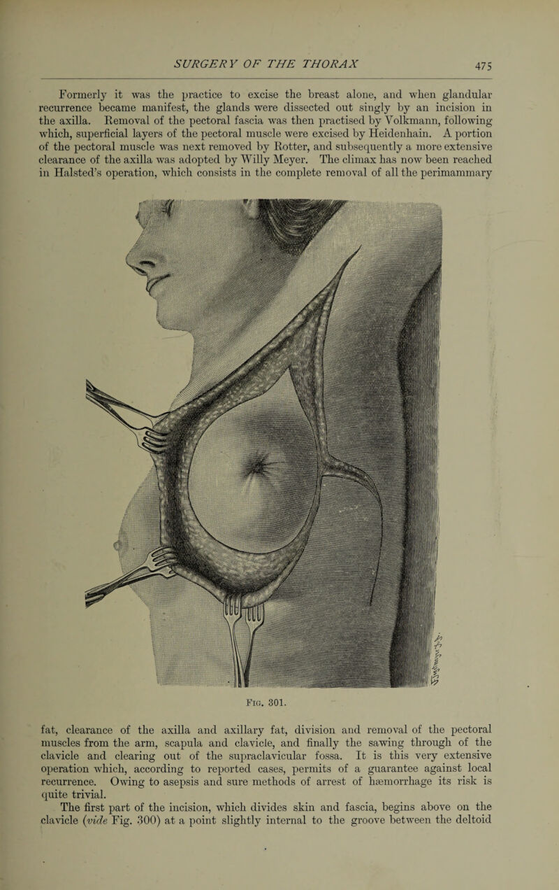 Formerly it was the practice to excise the breast alone, and when glandular recurrence became manifest, the glands were dissected out singly by an incision in the axilla. Removal of the pectoral fascia was then practised by Volkmann, following which, superficial layers of the pectoral muscle were excised by Heidenhain. A portion of the pectoral muscle was next removed by Rotter, and subsequently a more extensive clearance of the axilla was adopted by Willy Meyer. The climax has now been reached in Halsted’s operation, which consists in the complete removal of all the perimammary Fig. 301. fat, clearance of the axilla and axillary fat, division and removal of the pectoral muscles from the arm, scapula and clavicle, and finally the sawing through of the clavicle and clearing out of the supraclavicular fossa. It is this very extensive operation which, according to reported cases, permits of a guarantee against local recurrence. Owing to asepsis and sure methods of arrest of haemorrhage its risk is quite trivial. The first part of the incision, which divides skin and fascia, begins above on the clavicle (vide Fig. 300) at a point slightly internal to the groove between the deltoid