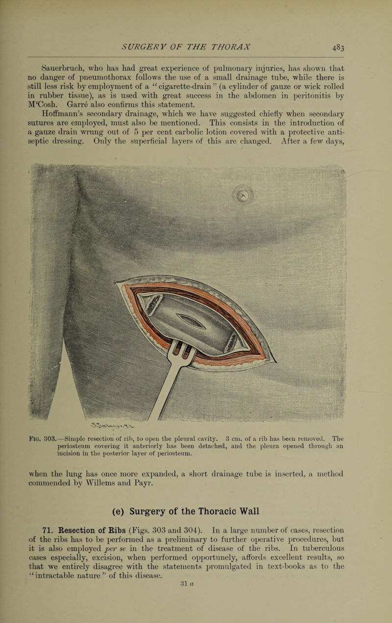 .Sauerbruch, who has had great experience of pulmonary injuries, has shown that no danger of pneumothorax follows the use of a small drainage tube, while there is still less risk by employment of a “ cigarette-drain ” (a cylinder of gauze or wick rolled in rubber tissue), as is used with great .success in the abdomen in peritonitis by M'Cosh. Garre also confirms this statement. Hoffmann’s secondary drainage, which we have suggested chiefly when secondary sutures are employed, must also be mentioned. This consists in the introduction of a gauze drain wrung out of 5 per cent carbolic lotion covered with a protective anti¬ septic dressing. Only the superficial layers of this are changed. After a few days, Fig. 303.—Simple resection of rib, to open the pleural cavity. 3 cm. of a rib has been removed. The periosteum covering it anteriorly has been detached, and the pleura opened through an incision in the posterior layer of periosteum. when the lung has once more expanded, a short drainage tube is inserted, a method commended by Willems and Payr. (e) Surgery of the Thoracic Wall 71. Resection of Ribs (Figs. 303 and 304). In a large number of cases, resection of the ribs has to be performed as a preliminary to further operative procedures, but it is also employed per se in the treatment of disease of the ribs. In tuberculous cases especially, excision, when performed opportunely, affords excellent results, so that we entirely disagree with the statements promulgated in text-books as to the ‘‘intractable nature ” of this disease.