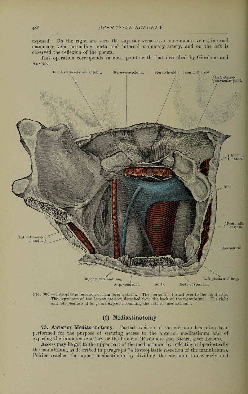 exposed. On the right are seen the superior vena cava, innominate veins, internal mammary vein, ascending aorta and internal mammary artery, and on the left is observed the reflexion of the pleura. This operation corresponds in most points with that described by Giordano and Auvray. Right sternoclavicular joint. Sterno-mastoid in. Sternohyoid and sterno-thyroid m. I Innomin l ate v. Rib. f Reft sterno- (clavicular joint. Int. mammary j a. and v. J f Pectoralis \ maj. m. rib. Aorta. Left pleura and lung. Body of sternum. Right pleura and lung. Sup. vena cava. Fig. 306.—Osteoplastic resection of manubrium sterni. The sternum is turned over to the right side. The depressors of the larynx are seen detached from the back of the manubrium. The right and left pleurae and lungs are exposed bounding the anterior mediastinum. (f) Mediastinotomy 75. Anterior Mediastinotomy. Partial excision of the sternum has often been performed for the purpose of securing access to the anterior mediastinum and of exposing the innominate artery or the bronchi (Rushmore and Ricard after Loisin). Access may be got to the upper part of the mediastinum by reflecting subperiosteally the manubrium, as described in paragraph 74 (osteoplastic resection of the manubrium). Poirier reaches the upper mediastinum by dividing the sternum transversely and