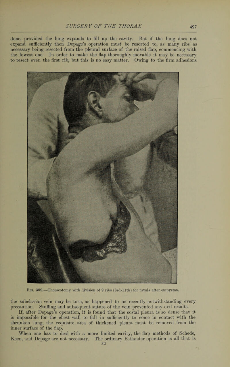 done, provided the lung expands to fill up the cavity. But if the lung does not expand sufficiently then Depage’s operation must be resorted to, as many ribs as necessary being resected from the pleural surface of the raised flap, commencing with the lowest one. In order to make the flap thoroughly movable it may be necessary to resect even the first rib, but this is no easy matter. Owing to the firm adhesions Fig. 309.—Thoracotomy with division of 9 ribs (3rd-llth) for fistula after empyema. the subclavian vein may be torn, as happened to us recently notwithstanding every precaution. Stuffing and subsequent suture of the vein prevented any evil results. If, after Depage’s operation, it is found that the costal pleura is so dense that it is impossible for the chest-wall to fall in sufficiently to come in contact with the shrunken lung, the requisite area of thickened pleura must be removed from the inner surface of the flap. When one has to deal with a more limited cavity, the flap methods of Schede, Keen, and Depage are not necessary. The ordinary Estländer operation is all that is 32