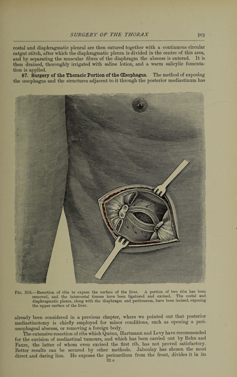 costal and diaphragmatic pleural are then sutured together with a continuous circular catgut stitch, after which the diaphragmatic pleura is divided in the centre of this area, and by separating the muscular fibres of the diaphragm the abscess is entered. It is then drained, thoroughly irrigated with saline lotion, and a warm salicylic fomenta¬ tion is applied. 87. Surgery of the Thoracic Portion of the (Esophagus. The method of exposing the oesophagus and the structures adjacent to it through the posterior mediastinum has Fig. 310.—Resection of ribs to expose the surface of the liver. A portion of two ribs has been removed, and the intercostal tissues have been ligatured and excised. The costal and diaphragmatic pleura, along with the diaphragm and peritoneum, have been incised, exposing the upper surface of the liver. already been considered in a previous chapter, where we pointed out that posterior mediastinotomy is chiefly employed for minor conditions, such as opening a peri- oesophageal abscess, or removing a foreign body. The extensive resection of ribs which Quenu, Hartmann and Levy have recommended for the excision of mediastinal tumours, and which has been carried out by Kehn and Faure, the latter of whom even excised the first rib, has not proved satisfactory. Better results can be secured by other methods. Jaboulay has chosen the most direct and daring line. He exposes the pericardium from the front, divides it in its 32 a