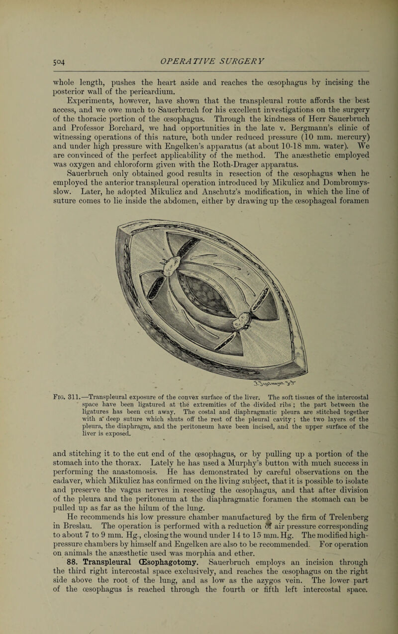 whole length, pushes the heart aside and reaches the oesophagus by incising the posterior wall of the pericardium. Experiments, however, have shown that the transpleural route affords the best access, and we owe much to Sauerbruch for his excellent investigations on the surgery of the thoracic portion of the oesophagus. Through the kindness of Herr Sauerbruch and Professor Borchard, we had opportunities in the late v. Bergmann’s clinic of witnessing operations of this nature, both under reduced pressure (10 mm. mercury) and under high pressure with Engelken’s apparatus (at about 10-18 mm. water). We are convinced of the perfect applicability of the method. The anaesthetic employed was oxygen and chloroform given with the Both-Drager apparatus. Sauerbruch only obtained good results in resection of the oesophagus when he employed the anterior transpleural operation introduced by Mikulicz and Dombromys- slow. Later, he adopted Mikulicz and Anschutz’s modification, in which the line of suture comes to lie inside the abdomen, either by drawing up the oesophageal foramen ’Y'S Fig. 311.—Transpleural exposure of the convex surface of the liver. The soft tissues of the intercostal space have been ligatured at the extremities of the divided ribs ; the part between the ligatures has been cut away. The costal and diaphragmatic pleura are stitched together with a’ deep suture which shuts off the rest of the pleural cavity ; the two layers of the pleura, the diaphragm, and the peritoneum have been incised, and the upper surface of the liver is exposed. and stitching it to the cut end of the oesophagus, or by pulling up a portion of the stomach into the thorax. Lately he has used a Murphy’s button with much success in performing the anastomosis. He has demonstrated by careful observations on the cadaver, which Mikulicz has confirmed on the living subject, that it is possible to isolate and preserve the vagus nerves in resecting the oesophagus, and that after division of the pleura and the peritoneum at the diaphragmatic foramen the stomach can be pulled up as far as the hilum of the lung. He recommends his low pressure chamber manufactured by the firm of Trelenberg in Breslau. The operation is performed with a reduction df air pressure corresponding to about 7 to 9 mm. Hg., closing the wound under 14 to 15 mm. Hg. The modified high- pressure chambers by himself and Engelken are also to be recommended. For operation on animals the anaesthetic used was morphia and ether. 88. Transpleural (Esophagotomy. Sauerbruch employs an incision through the third right intercostal space exclusively, and reaches the oesophagus on the right side above the root of the lung, and as low as the azygos vein. The lower part of the oesophagus is reached through the fourth or fifth left intercostal space.