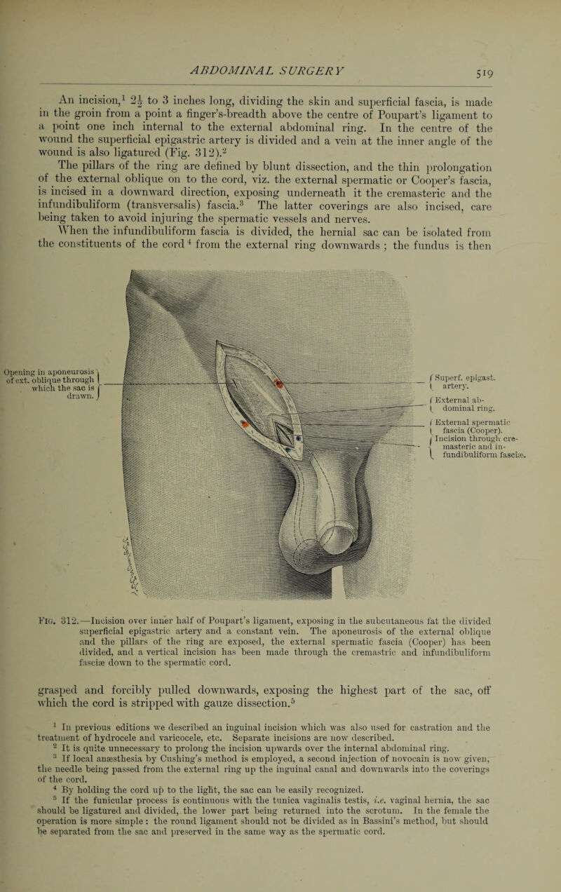 An incision,1 2^ to 3 inches long, dividing the skin and superficial fascia, is made in the groin from a point a finger’s-breadth above the centre of Poupart’s ligament to a point one inch internal to the external abdominal ring. In the centre of the wound the superficial epigastric artery is divided and a vein at the inner angle of the wound is also ligatured (Fig. 312).’2 The pillars of the ring are defined by blunt dissection, and the thin prolongation of the external oblique on to the cord, viz. the external spermatic or Cooper’s fascia, is incised in a downward direction, exposing underneath it the cremasteric and the infundibuliform (tranSversalis) fascia.3 The latter coverings are also incised, care being taken to avoid injuring the spermatic vessels and nerves. A hen the infundibuliform fascia is divided, the hernial sac can be isolated from the constituents of the cord 4 from the external ring downwards ; the fundus is then Opening in aponeurosis! of ext. oblique through | which the sac is f drawn. J /Superf. ejjigast. I artery. f External ab- |_ dominal ring. ( External spermatic ( fascia (Cooper). j Incision through cre- ■[ masteric and in- f fundibuliform fasciae. Fig. 312.—Incision over inner half of Poupart’s ligament, exposing in the subcutaneous fat the divided superficial epigastric artery and a constant vein. The aponeurosis of the external oblique and the pillars of the ring are exposed, the external spermatic fascia (Cooper) has been divided, and a vertical incision has been made through the cremastric and infundibuliform fasche down to the spermatic cord. grasped and forcibly pulled downwards, exposing the highest part of the sac, off which the cord is stripped with gauze dissection.5 1 In previous editions we described an inguinal incision which was also used for castration and the treatment of hydrocele and varicocele, etc. Separate incisions are now described. 2 It is quite unnecessary to prolong the incision upwards over the internal abdominal ring. If local anaesthesia by Cushing’s method is employed, a second injection of novocain is now given, the needle being passed from the external ring up the inguinal canal and downwards into the coverings of the cord. 4 By holding the cord up to the light, the sac can be easily recognized. 5 If the funicular process is continuous with the tunica vaginalis testis, i.e. vaginal hernia, the sac should be ligatured and divided, the lower part being returned into the scrotum. In the female the operation is more simple: the round ligament should not be divided as in Bassini’s method, but should be separated from the sac and preserved in the same way as the spermatic cord.