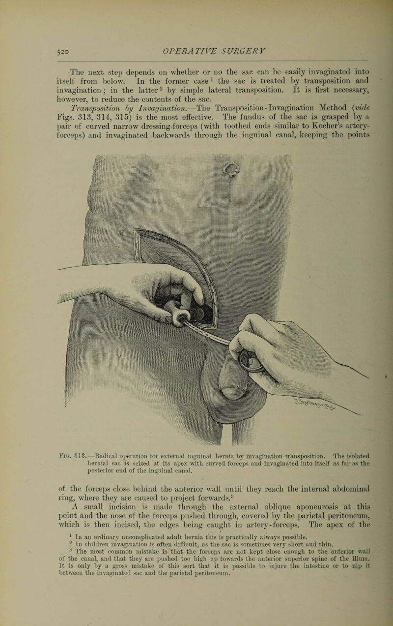 The next step depends on whether or no the sac can be easily invaginated into itself from below. In the former case1 the sac is treated by transposition and invagination; in the latter2 by simple lateral transposition. It is first necessary, however, to reduce the contents of the sac. Transposition Inj Invagination.—The Transposition-Invagination Method (vide Figs. 313, 314, 315) is the most effective. The fundus of the sac is grasped by a pair of curved narrow dressing-forceps (with toothed ends similar to Kocher’s artery- forceps) and invaginated backwards through the inguinal canal, keeping the points posterior end of the inguinal canal. of the forceps close behind the anterior wall until they reach the internal abdominal ring, where they are caused to project forwards.3 A small incision is made through the external oblique aponeurosis at this point and the nose of the forceps pushed through, covered by the parietal peritoneum, which is then incised, the edges being caught in artery - forceps. The apex of the 1 In an ordinary uncomplicated adult hernia this is practically always possible. 2 In children invagination is often difficult, as the sac is sometimes very short and thin. 3 The most common mistake is that the forceps are not kept close enough to the anterior wall of the canal, and that they are pushed too high up towards the anterior superior spine of the ilium. It is only by a gross mistake of this sort that it is possible to injure the intestine or to nip it between the invaginated sac and the parietal peritoneum.