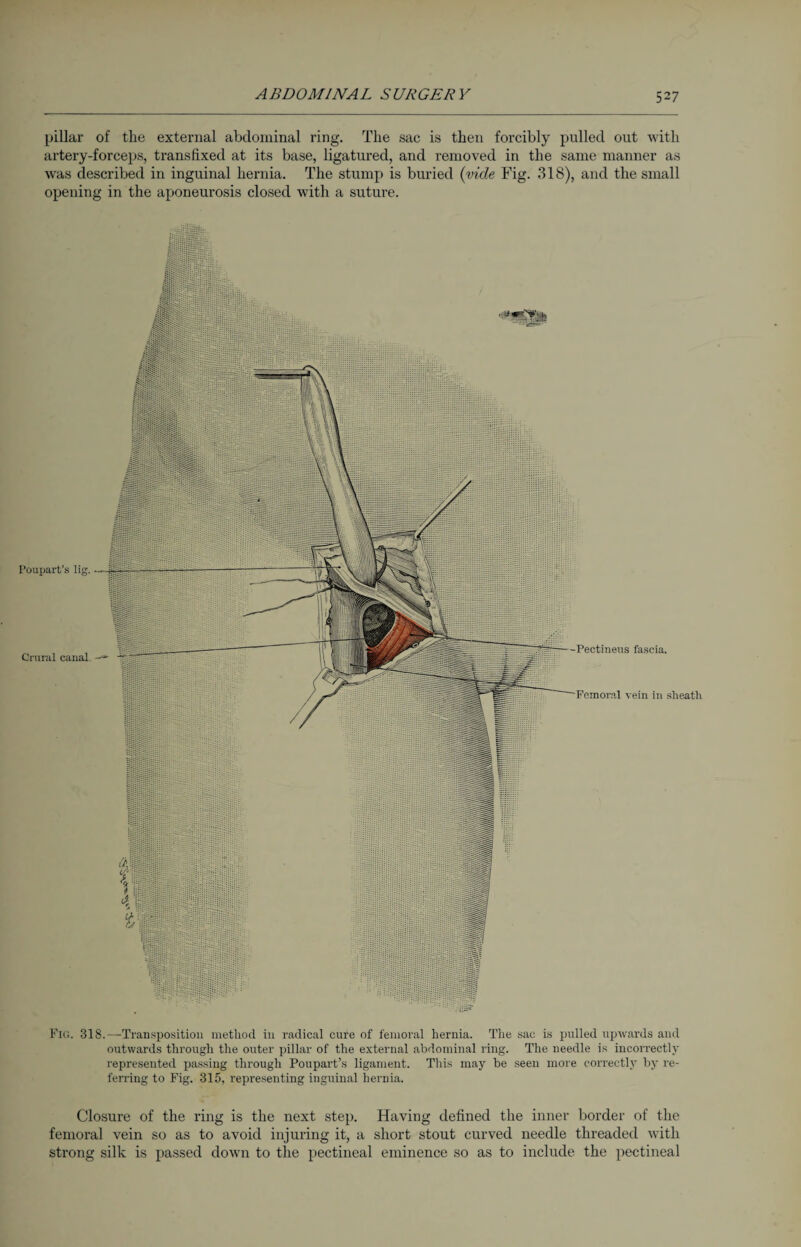 pillar of the external abdominal ring. The sac is then forcibly pulled out with artery-forceps, transfixed at its base, ligatured, and removed in the same manner as was described in inguinal hernia. The stump is buried (vide Fig. 318), and the small opening in the aponeurosis closed with a suture. Pig. 318.—Transposition method in radical cure of femoral hernia. The sac is pulled upwards and outwards through the outer pillar of the external abdominal ring. The needle is incorrectly represented passing through Poupart’.s ligament. This may he seen more correctly by re¬ ferring to Fig. 315, representing inguinal hernia. Closure of the ring is the next step. Having defined the inner border of the femoral vein so as to avoid injuring it, a short stout curved needle threaded with strong silk is passed down to the pectineal eminence so as to include the pectineal