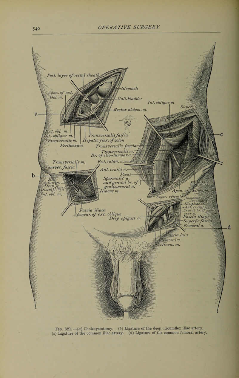 -Stomach Gall-bladder Int. oblique m 4— Rectus abdom. m Transversalis fascia •patic flex, of colon Transversalis fascia Transversalis vt.~i Br. of ilio-lumbar a.. m Ext. cutan. n.. ..Mm // Ant. crural n.— fflv\ Psoas—- 4|! Spermatic a. ■ 1 and genital br. oj Mil I genito-crural n. simO Iliacus vi. ffffSf ipoii. O-f0xtrqbl0§fßfß Super. c/'jca_s\:'u•/r.üirüiäl- Cr-lflfiHl . - in fj uiifflPPfl Iiio-fiso&s-i > fiBP-rl—-Ant. cru'ral ~WUMl—Frural br'°Jg00y orur.ii. ' ' —Fascia iliajFx^z^ uperf-fasen|g Femoral a. -f t iliaca of ext. oblique ^Efnioral 7> fectineus m Post, layer of rectal sheath. -Stomach 4— Rectus Transversalisfasfia Hepatic flex, of colon 1 Transversalis fascia Transversalis vir~) Br. of ilio-lumbar a.~7f) /cm n. Ext. cutan. n.. ..Mwi // ^ysffX Ant. crural n.— mjj^xNA Psoas—- ^m|! Spermatic a. «|i|al4 and genital br. oj IS'iMM genito-crural n. Iliacus in. f Transversal fansver. fascia 'fvu/ait&i.. fDeep \ frcumflMJ Hit. obi. m I Eascia iliaca Aponeur.of ext. oblique Fig. 321.—(a) Cholecystotomy. (b) Ligature of the deep circumflex iliac artery, (c) Ligature of the common iliac artery, (d) Ligature of the common femoral artery.