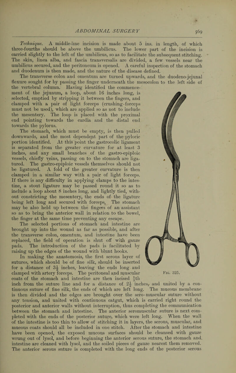 Technique. A middle-line incision is made about 5 ins. in length, of which three-fourths should be above the umbilicus. The lower part of the incision is carried slightly to the left of the umbilicus, so as to facilitate the subsequent stitching. The skin, linea alba, and fascia transversalis are divided, a few vessels near the umbilicus secured, and the peritoneum is opened. A careful inspection of the stomach and duodenum is then made, and the nature of the disease defined. The transverse colon and omentum are turned upwards, and the duodeno-jejunal flexure sought for by passing the finger underneath the mesocolon to the left side of the vertebral column. Having identified the commence¬ ment of the jejunum, a loop, about 16 inches long, is selected, emptied by stripping it between the fingers, and clamped with a pair of light forceps (crushing-forceps must not be used), which are applied so as not to include the mesentery. The loop is placed with the proximal end pointing towards the cardia and the distal end towards the pylorus. The stomach, which must be empty, is then pulled downwards, and the most dependent part of the pyloric portion identified. At this point the gastrocolic ligament is separated from the greater curvature for at least 3 inches, and any small branches of the gastro-epiploic vessels, chiefly veins, passing on to the stomach are liga¬ tured. The gastro-epiploic vessels themselves should not be ligatured. A fold of the greater curvature is then clamped in a similar way with a pair of light forceps. If there is any difficulty in applying clamps to the intes¬ tine, a stout ligature may be passed round it so as to include a loop about 8 inches long, and lightly tied, with¬ out constricting the mesentery, the ends of the ligature being left long and secured with forceps. The stomach may be also held up between the fingers of an assistant so as to bring the anterior wall in relation to the bowel, the linger at the same time preventing any escape. The selected portions of stomach and intestine are brought up into the wound as far as possible, and after the transverse colon, omentum, and intestine have been replaced, the field of operation is shut off with gauze pads. The introduction of the pads is facilitated by raising up the edges of the wound with blunt hooks. In making the anastomosis, the first serous layer of sutures, which should be of line silk, should be inserted for a distance of 3^ inches, leaving the ends long and clamped with artery forceps. The peritoneal and muscular Fig. 325. coats of the stomach and intestine are then incised -1th inch from the suture line and for a distance of 2| inches,- and united by a con¬ tinuous suture of fine silk, the ends of which are left long. The mucous membrane is then divided and the edges are brought over the sero-muscular suture without any tension, and united with continuous catgut, which is carried right round the posterior and anterior walls without interruption, thus completing the communication between the stomach and intestine. The anterior seromuscular suture is next com¬ pleted with the ends of the posterior suture, which wrere left long. When the wall of the intestine is too thin to allow of stitching it in layers, the serous, muscular, and mucous coats should all be included in one stitch. After the stomach and intestine have been opened, the exposed mucous surfaces should be cleansed with gauze wrung out of lysol, and before beginning the anterior serous suture, the stomach and,, intestine are cleaned with lysol, and the soiled pieces of gauze nearest them removed. The anterior serous suture is completed with the long ends of the posterior serous