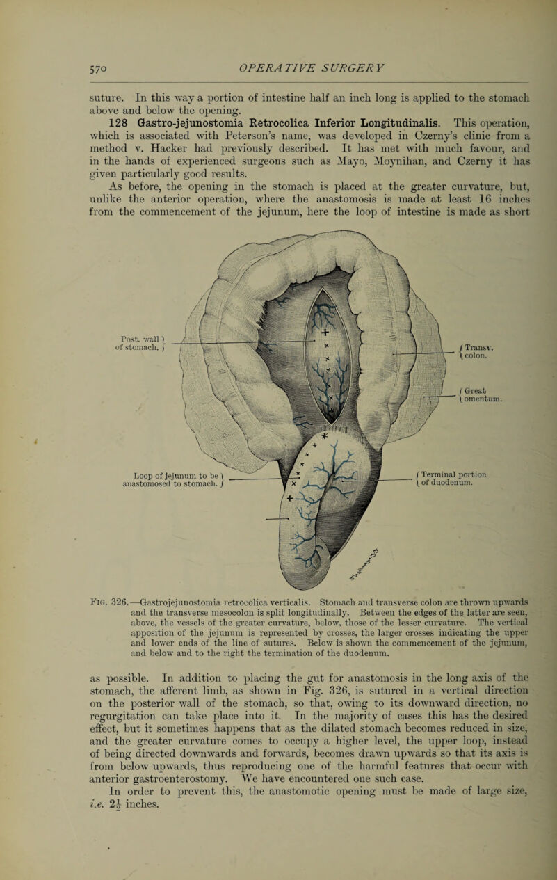 suture. In this way a portion of intestine half an inch long is applied to the stomach above and below the opening. 128 Gastro-jejunostomia Retrocolica Inferior Longitudinalis. This operation, which is associated with Peterson’s name, was developed in Czerny’s clinic from a method v. Hacker had previously described. It has met with much favour, and in the hands of experienced surgeons such as Mayo, Moynihan, and Czerny it has given particularly good results. As before, the opening in the stomach is placed at the greater curvature, but, unlike the anterior operation, where the anastomosis is made at least 16 inches from the commencement of the jejunum, here the loop of intestine is made as short Fig. 326.—Gastrojejuuostomia retroeolica verticalis. Stomach and transverse colon are thrown upwards and the transverse mesocolon is split longitudinally. Between the edges of the latter are seen, above, the vessels of the greater curvature, below, those of the lesser curvature. The vertical apposition of the jejunum is represented by crosses, the larger crosses indicating the upper and lower ends of the line of sutures. Below is shown the commencement of the jejunum, and below and to the right the termination of the duodenum. as possible. In addition to placing the gut for anastomosis in the long axis of the stomach, the afferent limb, as shown in Fig. 326, is sutured in a vertical direction on the posterior wall of the stomach, so that, owing to its downward direction, no regurgitation can take place into it. In the majority of cases this has the desired effect, but it sometimes happens that as the dilated stomach becomes reduced in size, and the greater curvature comes to occupy a higher level, the upper loop, instead of being directed downwards and forwards, becomes drawn upwards so that its axis is from below upwards, thus reproducing one of the harmful features that occur with anterior gastroenterostomy. We have encountered one such case. In order to prevent this, the anastomotic opening must be made of large size, i.e. 2b inches.