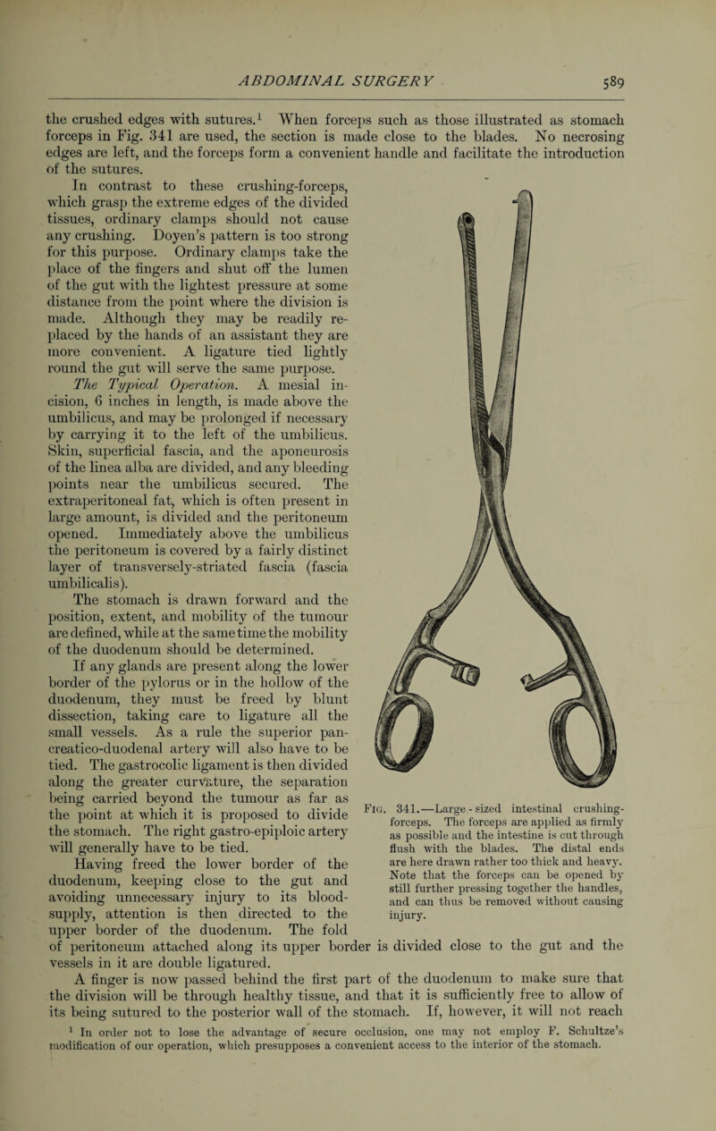 the crushed edges with sutures.1 When forceps such as those illustrated as stomach forceps in Fig. 341 are used, the section is made close to the blades. No necrosing edges are left, and the forceps form a convenient handle and facilitate the introduction of the sutures. In contrast to these crushing-forceps, which grasp the extreme edges of the divided tissues, ordinary clamps should not cause any crushing. Doyen’s pattern is too strong for this purpose. Ordinary clamps take the place of the fingers and shut off the lumen of the gut with the lightest pressure at some distance from the point where the division is made. Although they may be readily re¬ placed by the hands of an assistant they are more convenient. A ligature tied lightly round the gut will serve the same purpose. The Typical Operation. A mesial in¬ cision, 6 inches in length, is made above the umbilicus, and may be prolonged if necessary by carrying it to the left of the umbilicus. Skin, superficial fascia, and the aponeurosis of the linea alba are divided, and any bleeding- points near the umbilicus secured. The extraperitoneal fat, which is often present in large amount, is divided and the peritoneum opened. Immediately above the umbilicus the peritoneum is covered by a fairly distinct layer of transversely-striated fascia (fascia umbilicalis). The stomach is drawn forward and the position, extent, and mobility of the tumour are defined, while at the same time the mobility of the duodenum should be determined. If any glands are present along the lower border of the pylorus or in the hollow of the duodenum, they must be freed by blunt dissection, taking care to ligature all the small vessels. As a rale the superior pan- creatico-duodenal artery will also have to be tied. The gastrocolic ligament is then divided along the greater curvature, the separatiou being carried beyond the tumour as far as the point at which it is proposed to divide the stomach. The right gastro-epiploic artery will generally have to be tied. Having freed the lower border of the duodenum, keeping close to the gut and avoiding unnecessary injury to its blood- supply, attention is then directed to the Fig. 341.—Large-sized intestinal crushing- forceps. The forceps are applied as firmly as possible and the intestine is cut through flush with the blades. The distal ends are here drawn rather too thick and heavy. Note that the forceps can be opened by still further pressing together the handles, and can thus be removed without causing injury. upper border of the duodenum. The fold of peritoneum attached along its upper border is divided close to the gut and the vessels in it are double ligatured. A finger is now passed behind the first part of the duodenum to make sure that the division will be through healthy tissue, and that it is sufficiently free to allow of its being sutured to the posterior wall of the stomach. If, however, it will not reach 1 In order not to lose the advantage of secure occlusion, one may not employ F. Schultze’s modification of our operation, which presupposes a convenient access to the interior of the stomach.