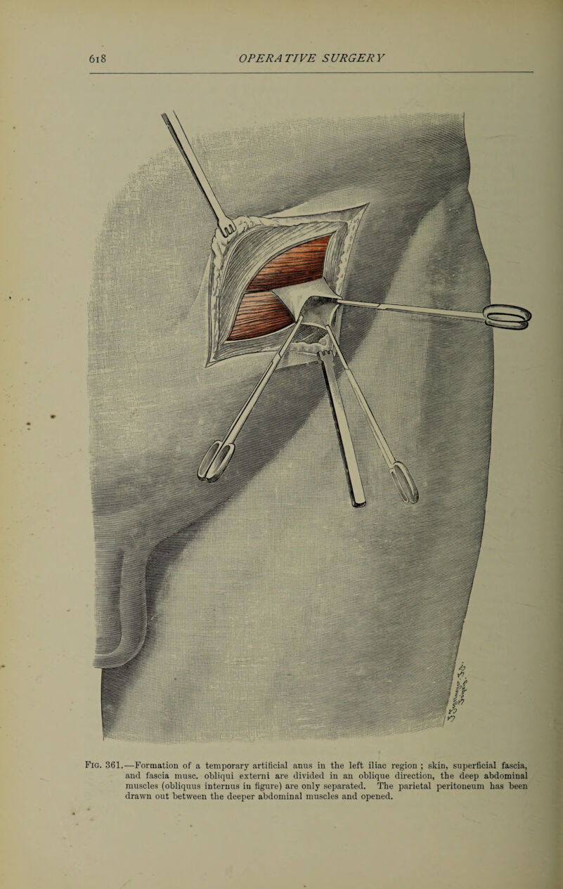 Fig. 361..—Formation of a temporary artificial anus in the left iliac region ; skin, superficial fascia, and fascia muse, obliqui externi are divided in an oblique direction, the deep abdominal muscles (obliquus internus iu figure) are only separated. The parietal peritoneum has been drawn out between the deeper abdominal muscles and opened.