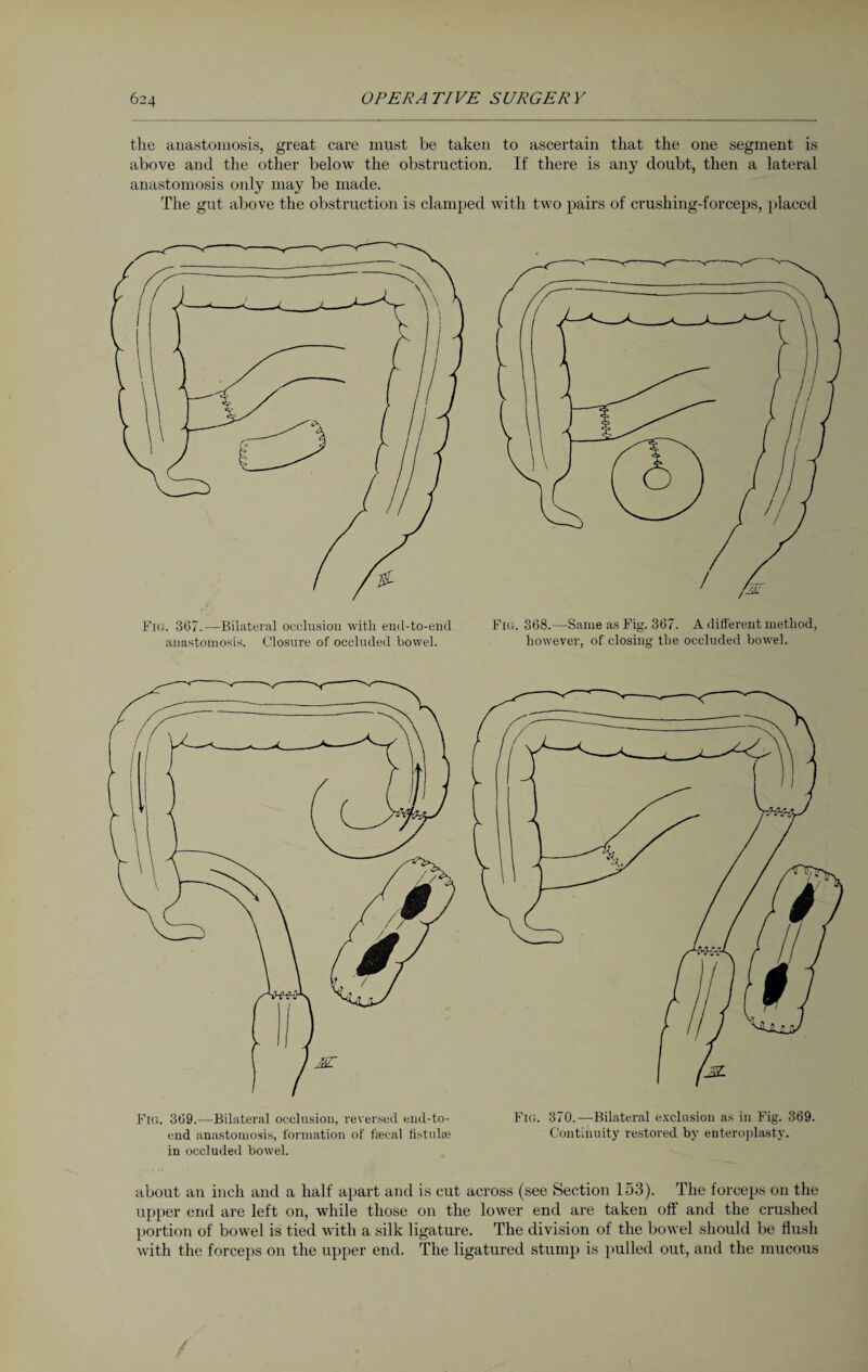 the anastomosis, great care must be taken to ascertain that the one segment is above and the other below the obstruction. If there is any doubt, then a lateral anastomosis only may be made. The gut above the obstruction is clamped with two pairs of crushing-forceps, placed Fig. 367.—Bilateral occlusion with end-to-end Fig. 368.—Same as Fig. 367. A different method, anastomosis. Closure of occluded bowel. however, of closing the occluded bowel. Fig. 369.—Bilateral occlusion, reversed end-to- Fig. 370.—Bilateral exclusion as in Fig. 369. end anastomosis, formation of fsecal fistulse Continuity restored by enteroplasty. in occluded bowel. about an inch and a half apart and is cut across (see Section 153). The forceps on the upper end are left on, while those on the lower end are taken off and the crushed portion of bowel is tied with a silk ligature. The division of the bowel should be flush with the forceps on the upper end. The ligatured stump is pulled out, and the mucous