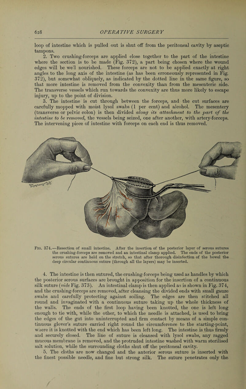 loop of intestine which is pulled out is shut off from the peritoneal cavity by aseptic tampons. 2. Two crushing-forceps are applied close together to the part of the intestine where the section is to be made (Fig. 372), a part being chosen where the wound edges will be well nourished. These forceps are not to be applied exactly at right angles to the long axis of the intestine (as has been erroneously represented in Fig. 372), but somewhat obliquely, as indicated by the dotted line in the same figure, so that more intestine is removed from the convexity than from the mesenteric side. The transverse vessels which run towards the convexity are thus more likely to escape injury, up to the point of division. 3. The intestine is cut through between the forceps, and the cut surfaces are carefully mopped with moist lysol swabs (1 per cent) and alcohol. The mesentery (transverse or pelvic colon) is then divided along its attachment to the part of the intestine to be removed, the vessels being seized, one after another, with artery-forceps. The intervening piece of intestine with forceps on each end is thus removed. Fig. 374.—Resection of small intestine. After the insertion of the posterior layer of serous sutures the crushing-forceps are removed and an intestinal clamp applied. The ends of the posterior serous sutures are held on the stretch, so that after thorough disinfection of the bowel the deep circular continuous suture (through all the layers) may be inserted. 4. The intestine is then sutured, the crushing-forceps being used as handles by which the posterior serous surfaces are brought in apposition for the insertion of a continuous silk suture (vide Fig. 373). An intestinal clamp is then applied as is shown in Fig. 374, and the crushing-forceps are removed, alter cleansing the divided ends with small gauze swabs and carefully protecting against soiling. The edges are then stitched all round and invaginated with a continuous suture taking up the whole thickness of the walls. The ends of the first loop having been knotted, the one is left long enough to tie with, while the other, to which the needle is attached, is used to bring the edges of the gut into uninterrupted and firm contact by means of a simple con¬ tinuous glover’s suture carried right round the circumference to the starting-point, wnere it is knotted with the end which has been left long. The intestine is thus firmly and securely closed. The line of suture is cleansed with lysol swabs, any ragged mucous membrane is removed, and the protruded intestine washed with warm sterilised salt solution, while the surrounding cloths shut off the peritoneal cavity. 5. The cloths are now changed and the anterior serous suture is inserted with the finest possible needle, and fine but strong silk. The suture penetrates only the