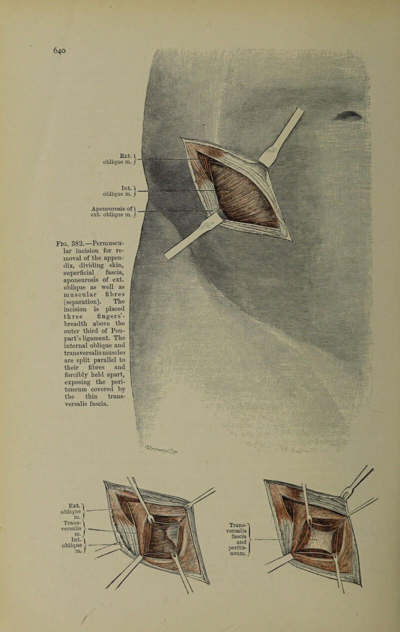 Ext. 1 oblique m. j Int. 1 oblique m. J Aponeurosis of 4 ext. oblique m. / Fig. 382.—Permuscu- lar incision for re¬ moval of the appen¬ dix, dividing skin, superficial fascia, aponeurosis of ext. oblique as well as muscular fibres (separation). The incision is placed three fingers’- breadth above the outer third of Pou- part’s ligament. The internal oblique and transversalis muscles are split parallel to their fibres and forcibly held apart, exposing the peri¬ toneum covered by the thin trans¬ versalis fascia. Trans-A versalis I fascia I and j perito¬ neum. J