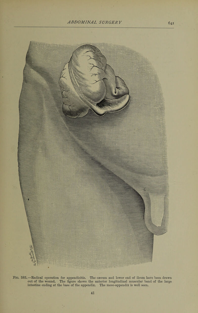 Fig. 383.—Radical operation for appendicitis. The caecum and lower end of ileum have been drawn out of the wound. The figure shows the anterior longitudinal muscular band of the large intestine ending at the base of the appendix. The meso-appendix is well seen. 41