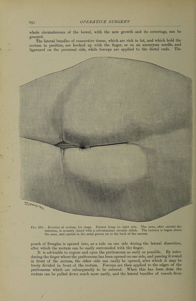 whole circumference of the bowel, with the new growth and its coverings, can be grasped. The lateral bundles of connective tissue, which are rich in fat, and which hold the rectum in position, are hooked up with the finger, or on an aneurysm needle, and ligatured on the proximal side, while forceps are applied to the distal ends. The Fig. 385. — Excision of rectum, 1st stage. Patient lying 011 right side. The anus, after careful dis¬ infection, is securely closed with a subcutaneous circular stitch. The incision is begun above the anus, and carried in the natal groove on to the back of the sacrum. pouch of Douglas is opened into, as a rule on one side during the lateral dissection, after which the rectum can be easily surrounded with the finger. It is advisable to expose and open the peritoneum as early as possible. By intro¬ ducing the finger where the peritoneum has been opened on one side, and passing it round in front of the rectum, the other side can easily be opened, after which it may be freely divided in front of the rectum. Forceps are then applied to the edges of the peritoneum which are subsequently to be sutured. When this has been done the rectum can be pulled down much more easily, and the lateral bundles of vessels from