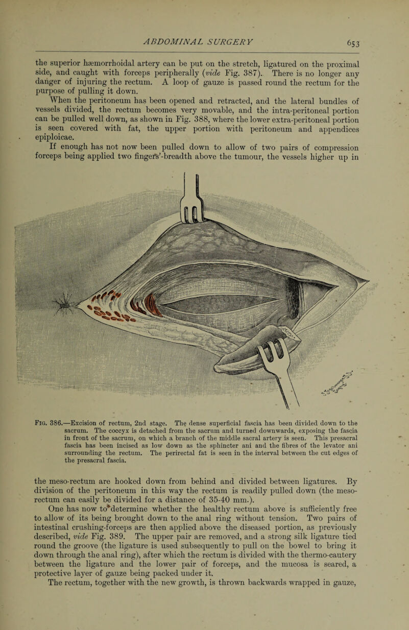 the superior hemorrhoidal artery can be put on the stretch, ligatured on the proximal side, and caught with forceps peripherally (vide Fig. 387). There is no longer any danger of injuring the rectum. A loop of gauze is passed round the rectum for the purpose of pulling it down. When the peritoneum has been opened and retracted, and the lateral bundles of vessels divided, the rectum becomes very movable, and the intra-peritoneal portion can be pulled well down, as shown in Fig. 388, where the lower extra-peritoneal portion is seen covered with fat, the upper portion with peritoneum and appendices epiploicae. If enough has not now been pulled down to allow of two pairs of compression forceps being applied two fingers’-breadth above the tumour, the vessels higher up in Fig. 386.—Excision of rectum, 2nd stage. The dense superficial fascia has been divided down to the sacrum. The coccyx is detached from the sacrum and turned downwards, exposing the fascia in front of the sacrum, on which a branch of the middle sacral artery is seen. This presacral fascia has been incised as low down as the sphincter ani and the fibres of the levator ani surrounding the rectum. The perirectal fat is seen in the interval between the cut edges of the presacral fascia. the meso-rectum are hooked down from behind and divided between ligatures. By division of the peritoneum in this way the rectum is readily pulled down (the meso- rectum can easily be divided for a distance of 35-40 mm.). One has now toMetermine whether the healthy rectum above is sufficiently free to allow of its being brought down to the anal ring without tension. Two pairs of intestinal crushing-forceps are then applied above the diseased portion, as previously described, vide Fig. 389. The upper pair are removed, and a strong silk ligature tied round the groove (the ligature is used subsequently to pull on the bowel to bring it down through the anal ring), after which the rectum is divided with the thermo-cautery between the ligature and the lower pair of forceps, and the mucosa is seared, a protective layer of gauze being packed under it. The rectum, together with the new growth, is thrown backwards wrapped in gauze,