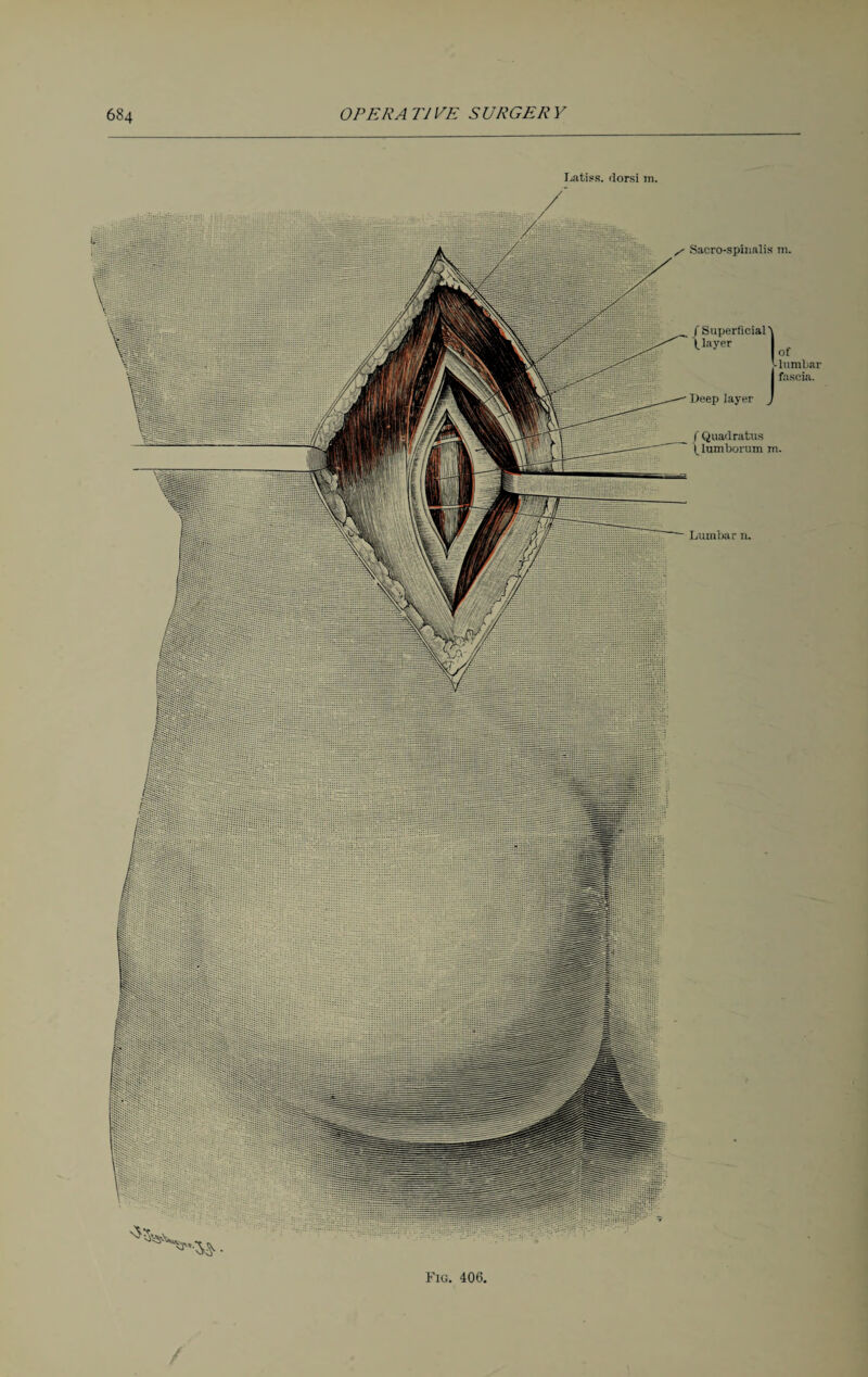 Latiss. florsi m. Lumbar n. / Sacro-spinalis m. / Superficial \ layer I J-lumliar I fascia. Deep layer J f Quadratus \ lumborum m. Fig. 406.